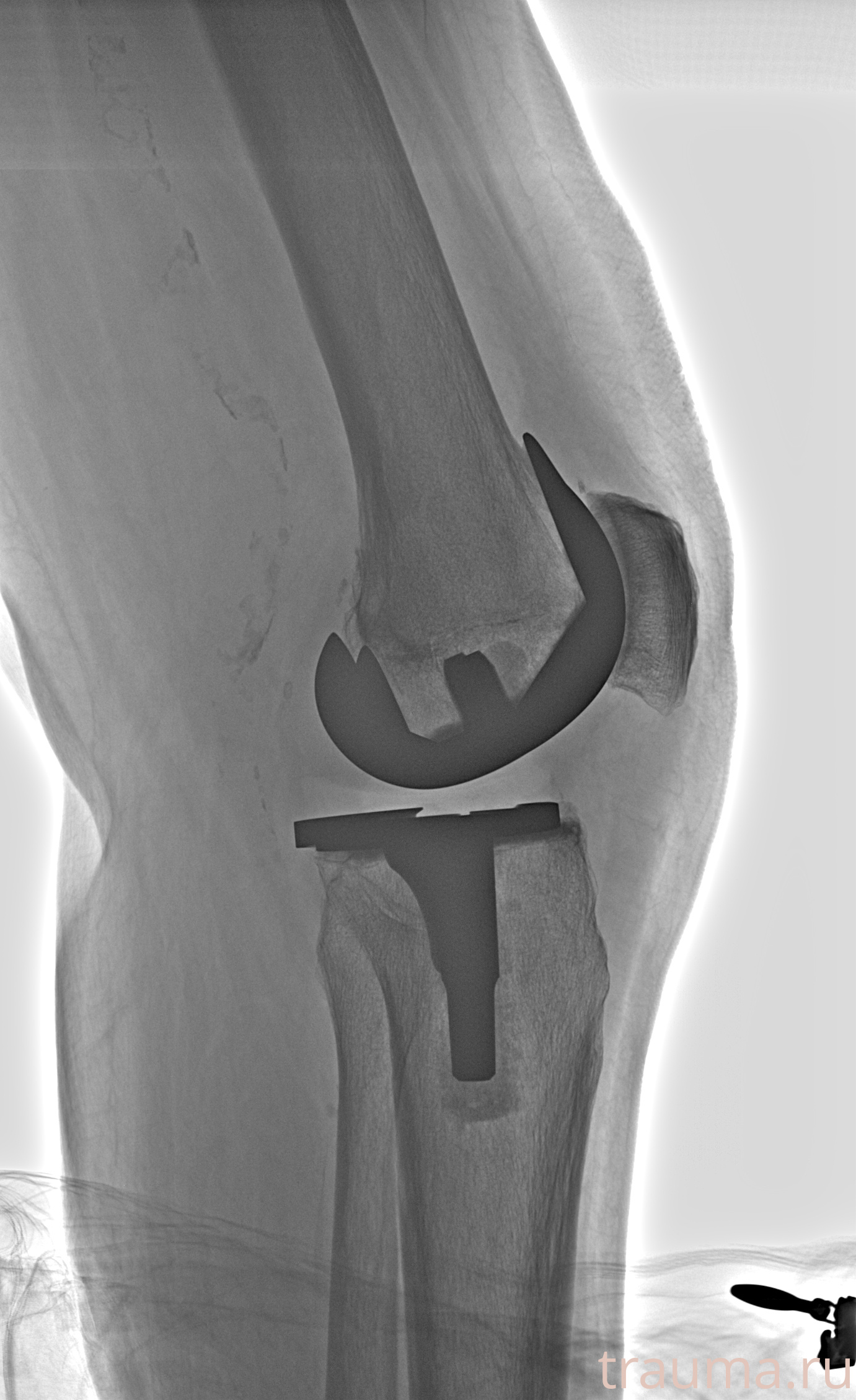Рентген на дому: по вашему адресу приезжает врач-рентгенолог, травматолог-ортопед с мобильным рентгеновским аппаратом, проводит диагностику травмы или заболевания, делает необходимые рентгенограммы, дает рекомендации по дальнейшему лечению. Получить качественные снимки в домашних условиях возможно благодаря уникальной методике, разработанной МосРентген Центром для института  Склифосовского