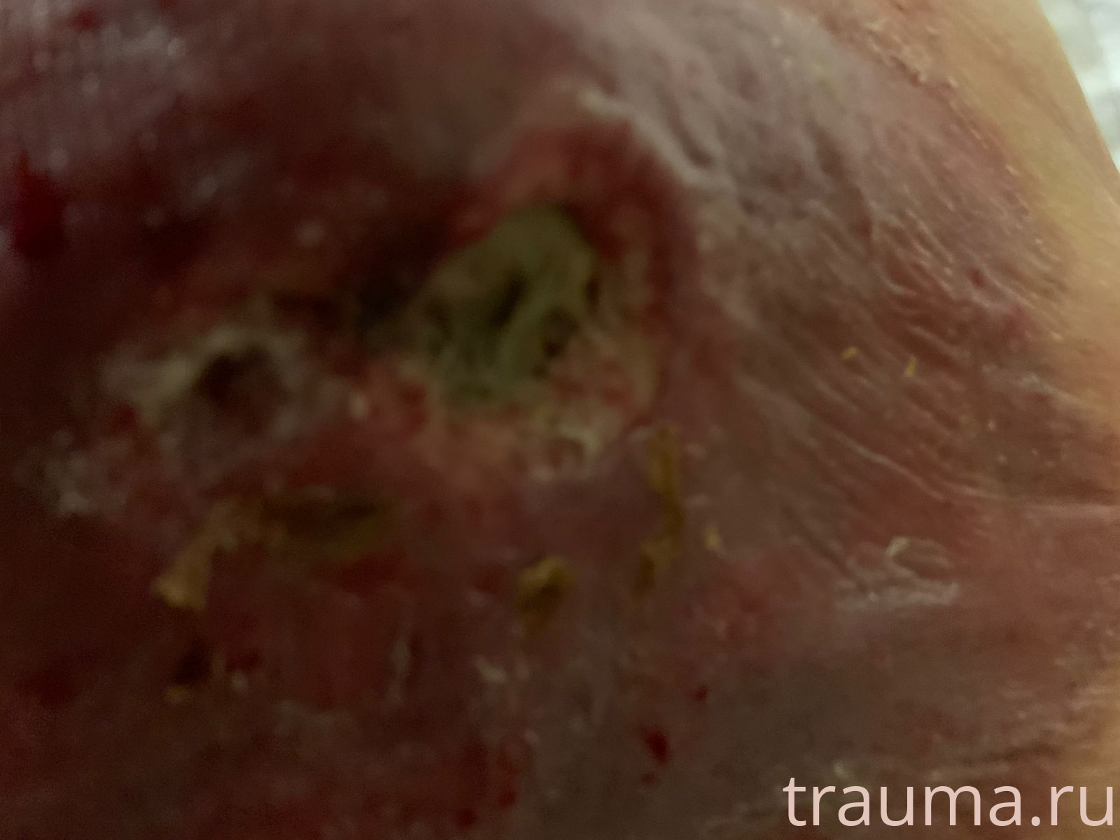 Рентген на дому: по вашему адресу приезжает врач-рентгенолог, травматолог-ортопед с мобильным рентгеновским аппаратом, проводит диагностику травмы или заболевания, делает необходимые рентгенограммы, дает рекомендации по дальнейшему лечению. Получить качественные снимки в домашних условиях возможно благодаря уникальной методике, разработанной МосРентген Центром для института  Склифосовского