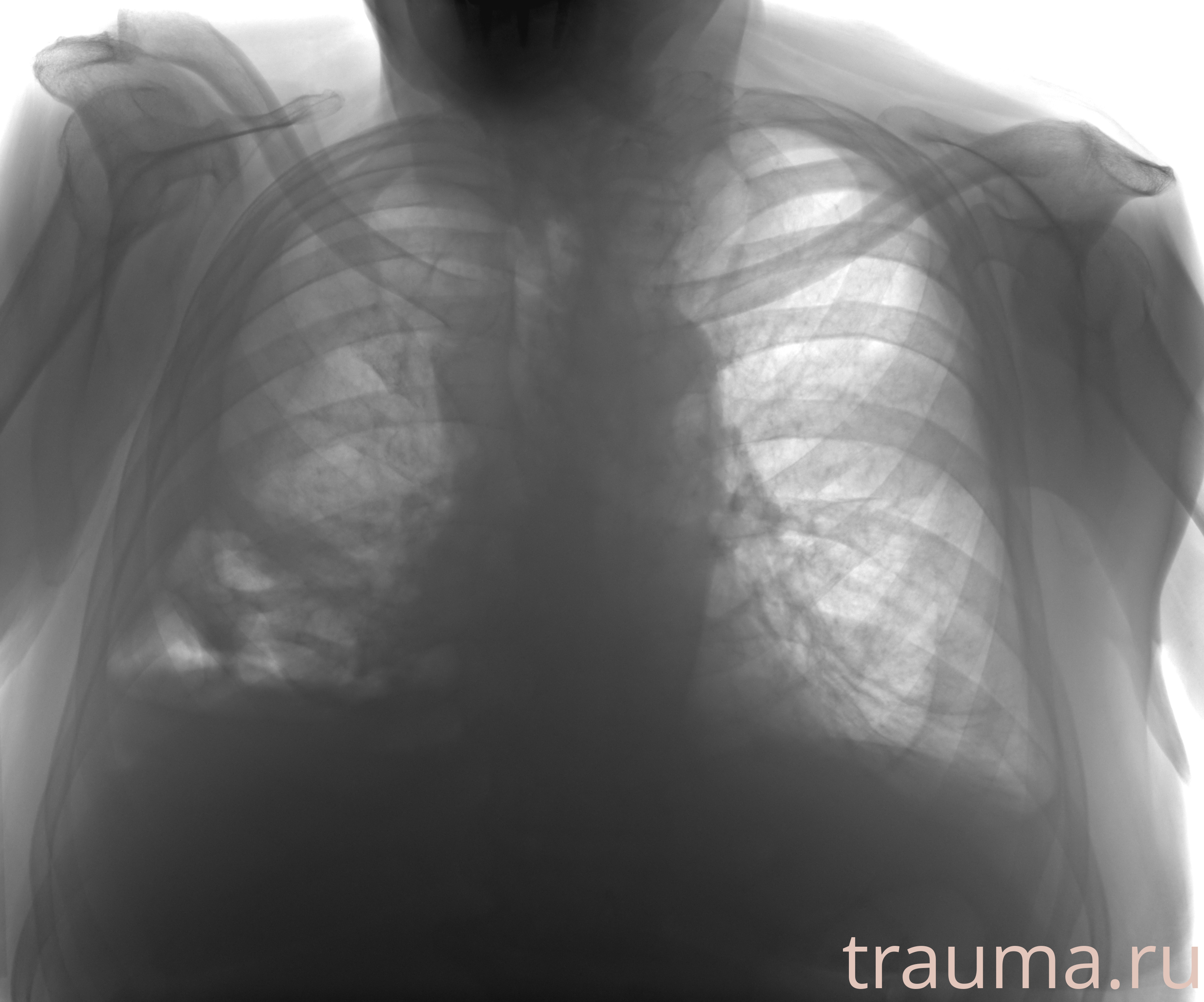Рентген на дому: по вашему адресу приезжает врач-рентгенолог, травматолог-ортопед с мобильным рентгеновским аппаратом, проводит диагностику травмы или заболевания, делает необходимые рентгенограммы, дает рекомендации по дальнейшему лечению. Получить качественные снимки в домашних условиях возможно благодаря уникальной методике, разработанной МосРентген Центром для института  Склифосовского