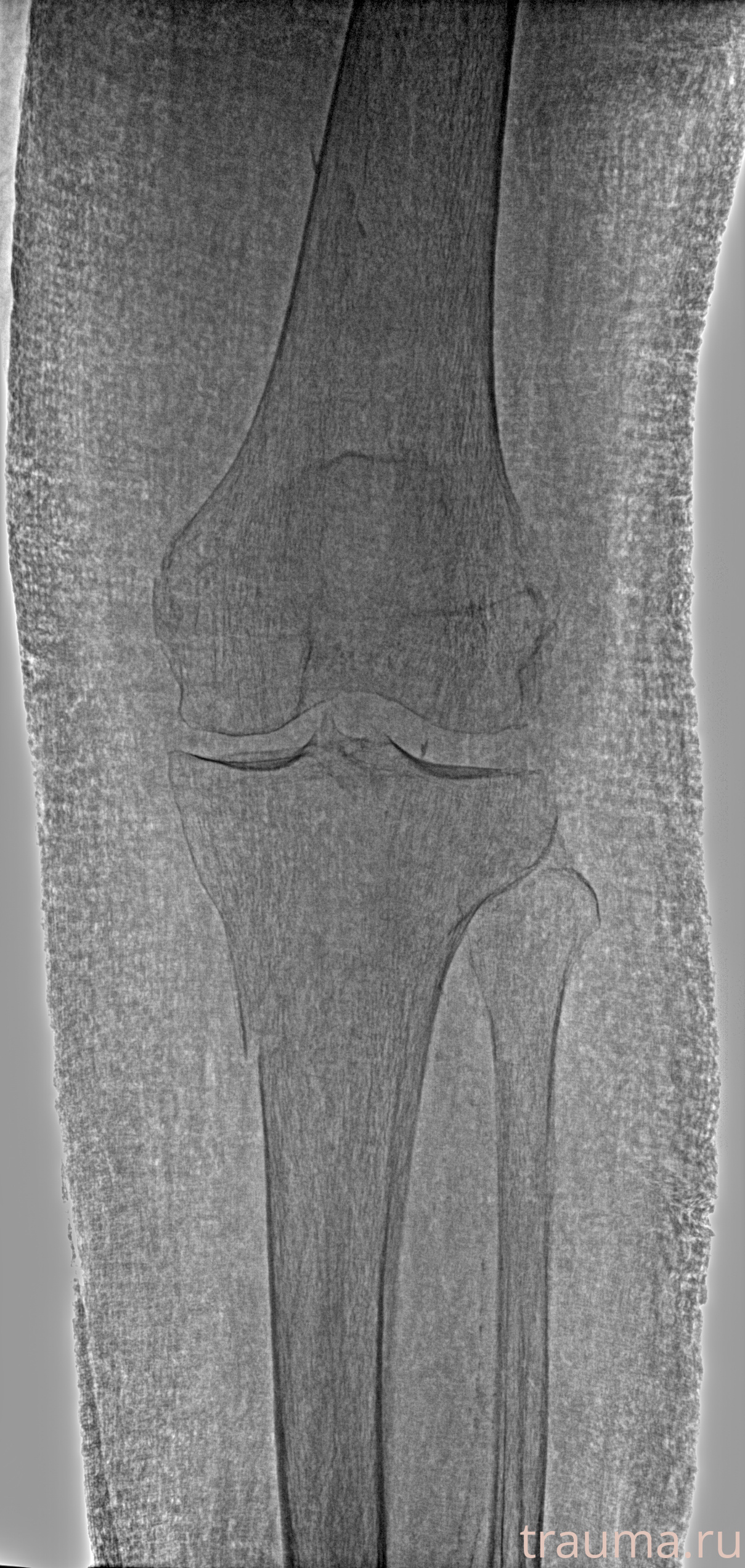 Рентген на дому: по вашему адресу приезжает врач-рентгенолог, травматолог-ортопед с мобильным рентгеновским аппаратом, проводит диагностику травмы или заболевания, делает необходимые рентгенограммы, дает рекомендации по дальнейшему лечению. Получить качественные снимки в домашних условиях возможно благодаря уникальной методике, разработанной МосРентген Центром для института  Склифосовского