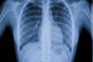 Рентген грудной клетки на дому при воспалении легких