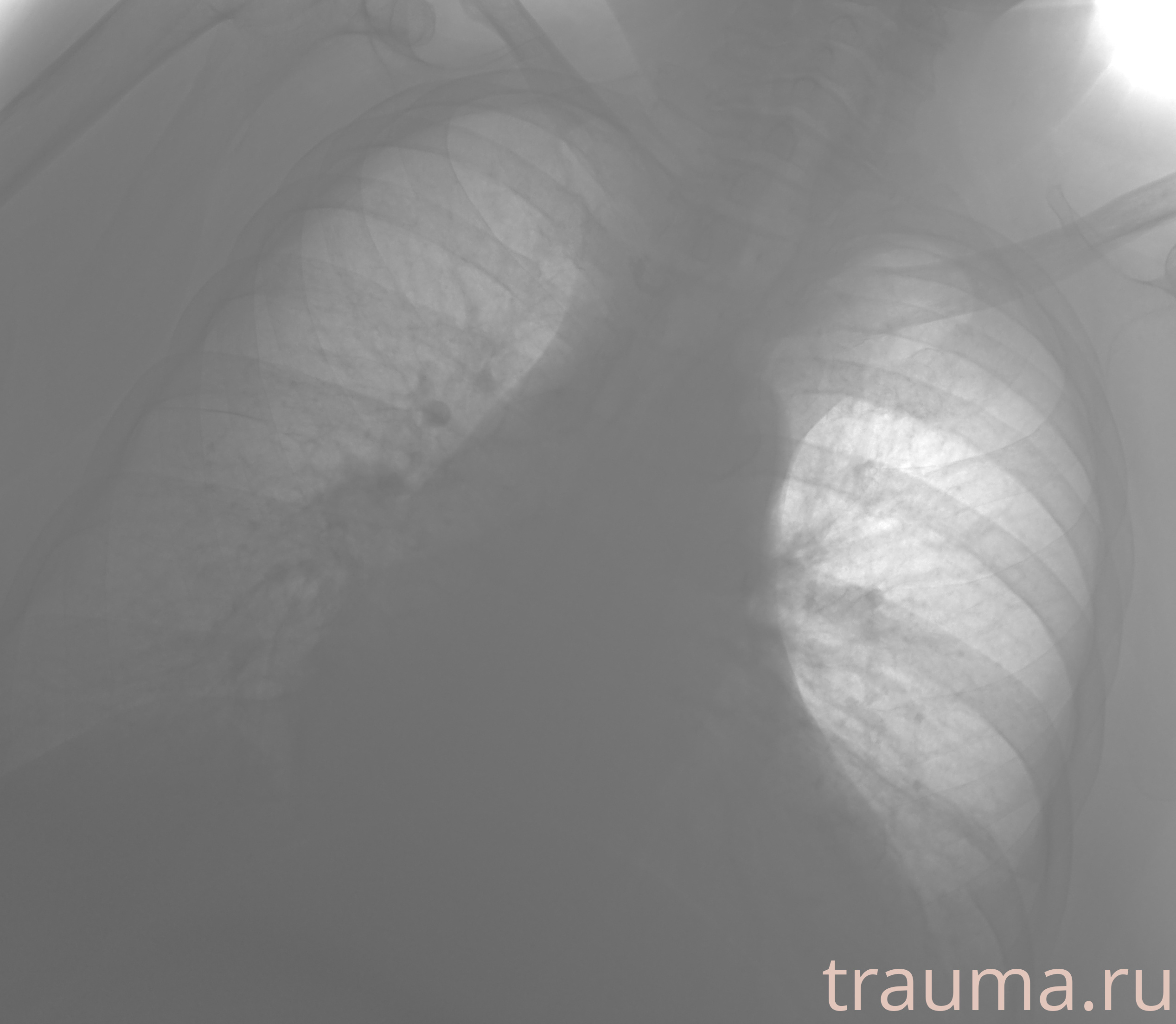 Рентген на дому: по вашему адресу приезжает врач-рентгенолог, травматолог-ортопед с мобильным рентгеновским аппаратом, проводит диагностику травмы или заболевания, делает необходимые рентгенограммы, дает рекомендации по дальнейшему лечению. Получить качественные снимки в домашних условиях возможно благодаря уникальной методике, разработанной МосРентген Центром для института  Склифосовского