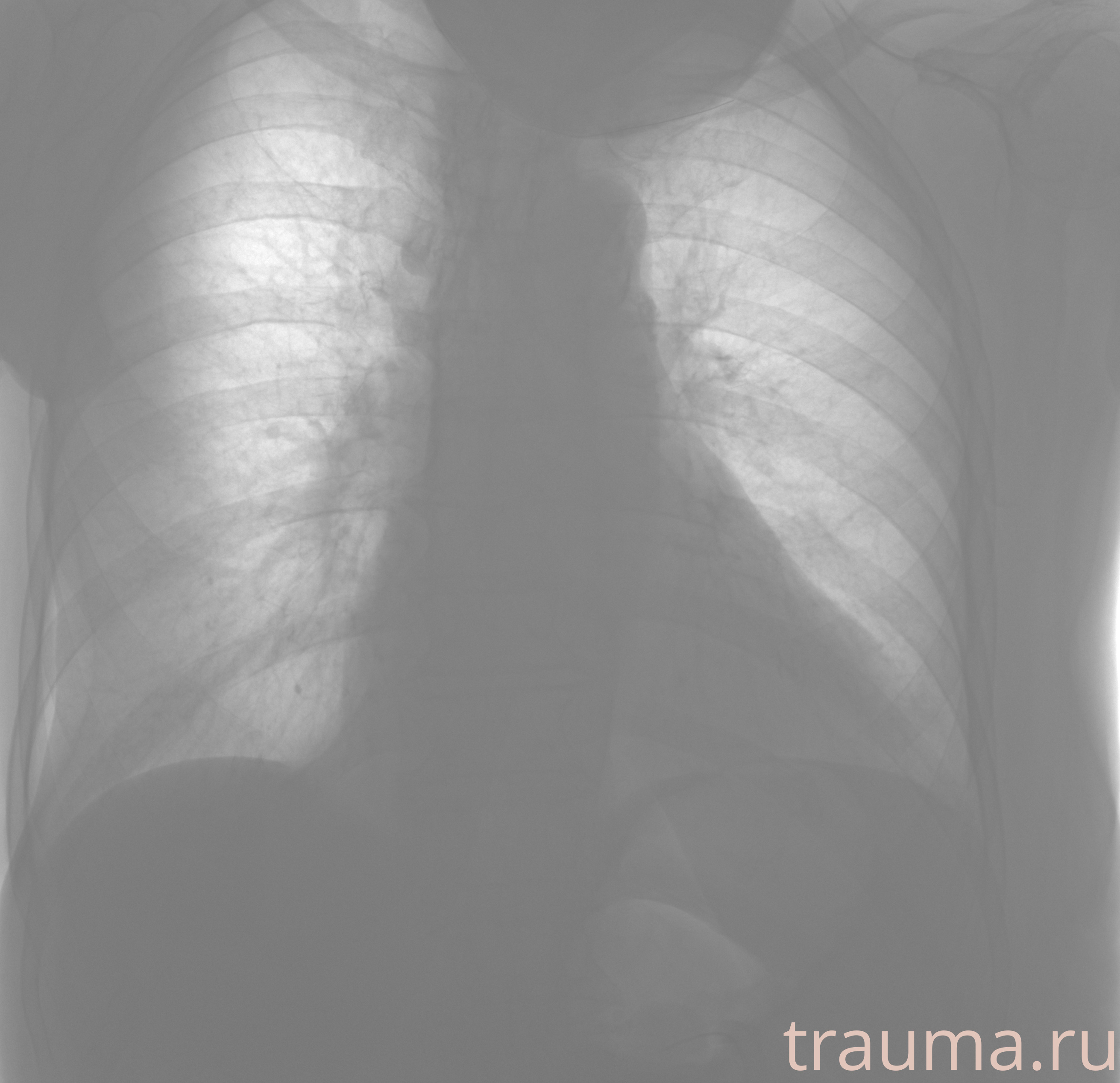 Рентген на дому: по вашему адресу приезжает врач-рентгенолог, травматолог-ортопед с мобильным рентгеновским аппаратом, проводит диагностику травмы или заболевания, делает необходимые рентгенограммы, дает рекомендации по дальнейшему лечению. Получить качественные снимки в домашних условиях возможно благодаря уникальной методике, разработанной МосРентген Центром для института  Склифосовского