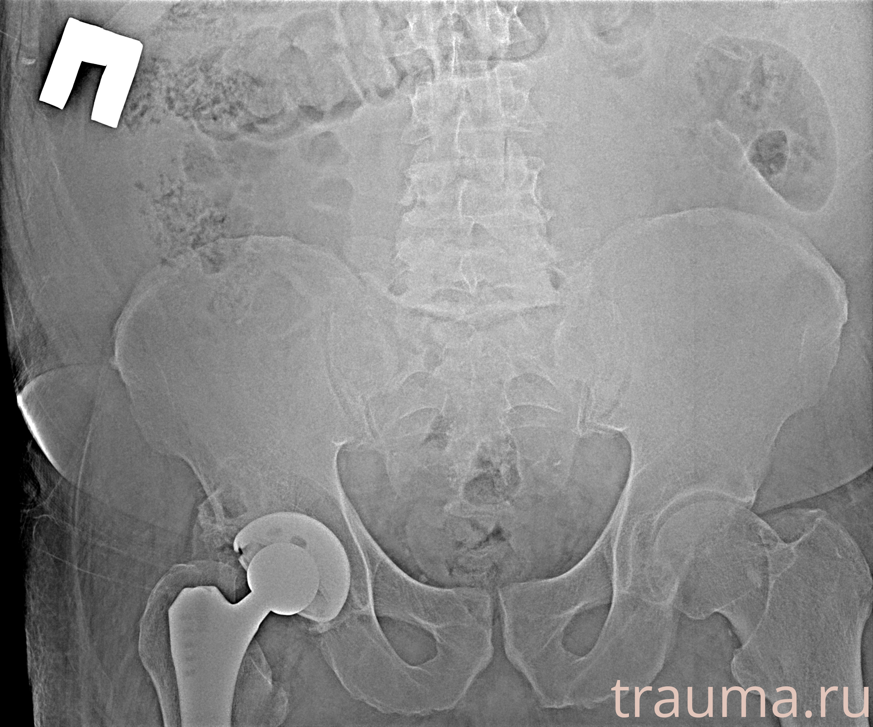 Рентген на дому: по вашему адресу приезжает врач-рентгенолог, травматолог-ортопед с мобильным рентгеновским аппаратом, проводит диагностику травмы или заболевания, делает необходимые рентгенограммы, дает рекомендации по дальнейшему лечению. Получить качественные снимки в домашних условиях возможно благодаря уникальной методике, разработанной МосРентген Центром для института  Склифосовского