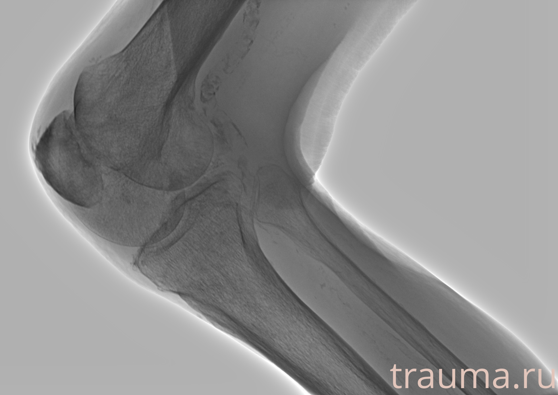 Рентген на дому: по вашему адресу приезжает врач-рентгенолог, травматолог-ортопед с мобильным рентгеновским аппаратом, проводит диагностику травмы или заболевания, делает необходимые рентгенограммы, дает рекомендации по дальнейшему лечению. Получить качественные снимки в домашних условиях возможно благодаря уникальной методике, разработанной МосРентген Центром для института  Склифосовского