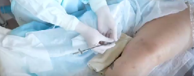 Из-за варикоза нога пациентки обратилась в Склиф Из-за варикоза нога пациентки обратилась в Склиф