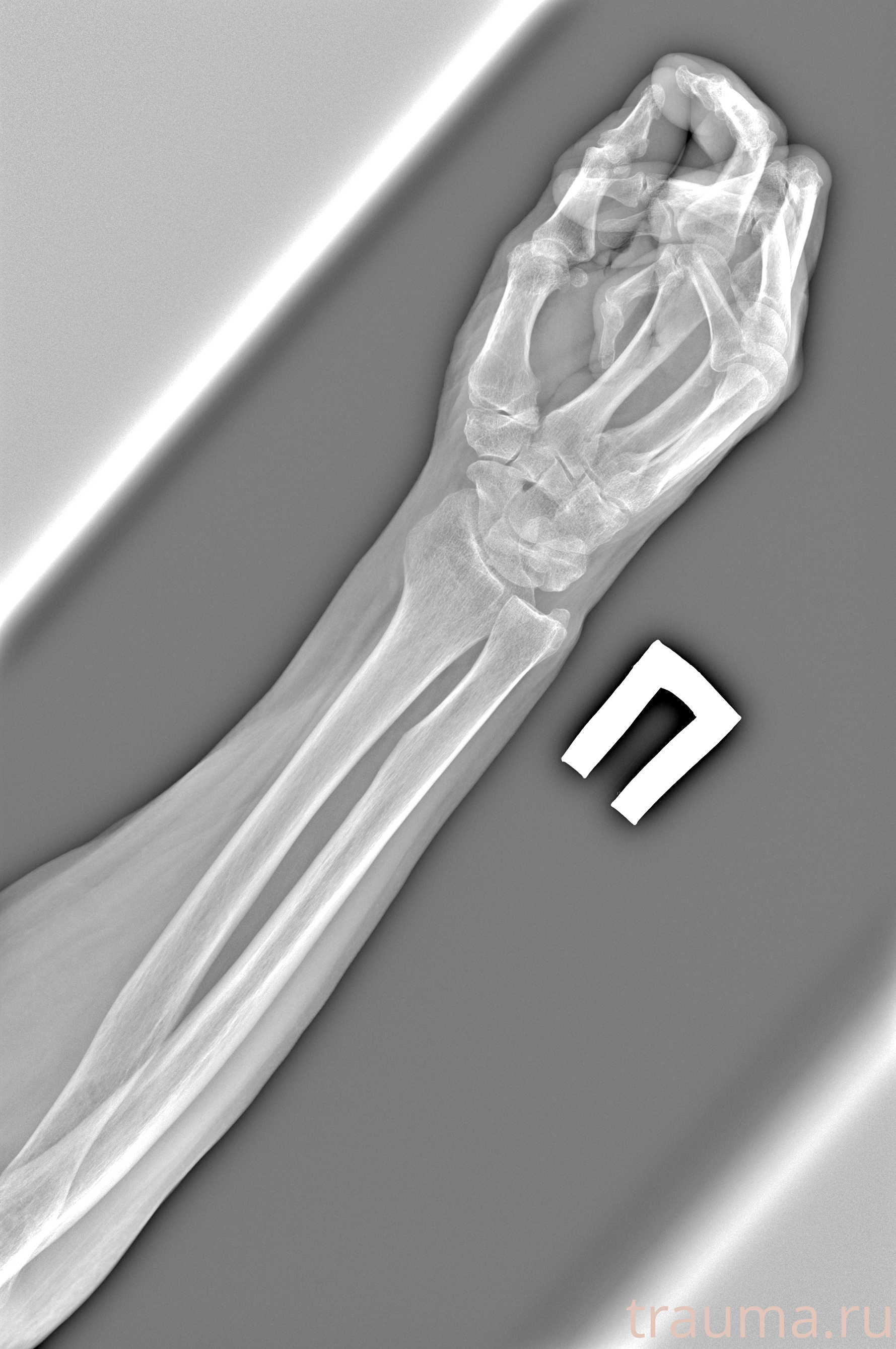 Рентген на дому: по вашему адресу приезжает врач-рентгенолог, травматолог-ортопед с мобильным рентгеновским аппаратом, проводит диагностику травмы или заболевания, делает необходимые рентгенограммы, дает рекомендации по дальнейшему лечению. Получить качественные снимки в домашних условиях возможно благодаря уникальной методике, разработанной МосРентген Центром для института  Склифосовского