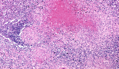 В России зафиксировано наибольшее число случаев туберкулеза в Европейском регионе ВОЗ