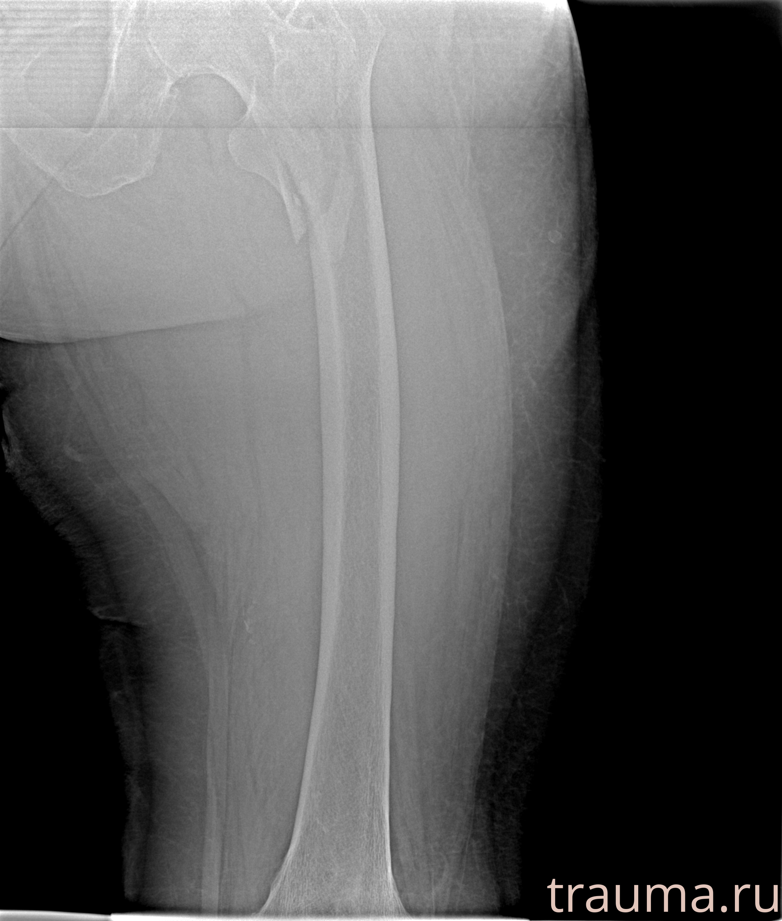 Рентген на дому: по вашему адресу приезжает врач-рентгенолог, травматолог-ортопед с мобильным рентгеновским аппаратом, проводит диагностику травмы или заболевания, делает необходимые рентгенограммы, дает рекомендации по дальнейшему лечению. Получить качественные снимки в домашних условиях возможно благодаря уникальной методике, разработанной МосРентген Центром для института  Склифосовского