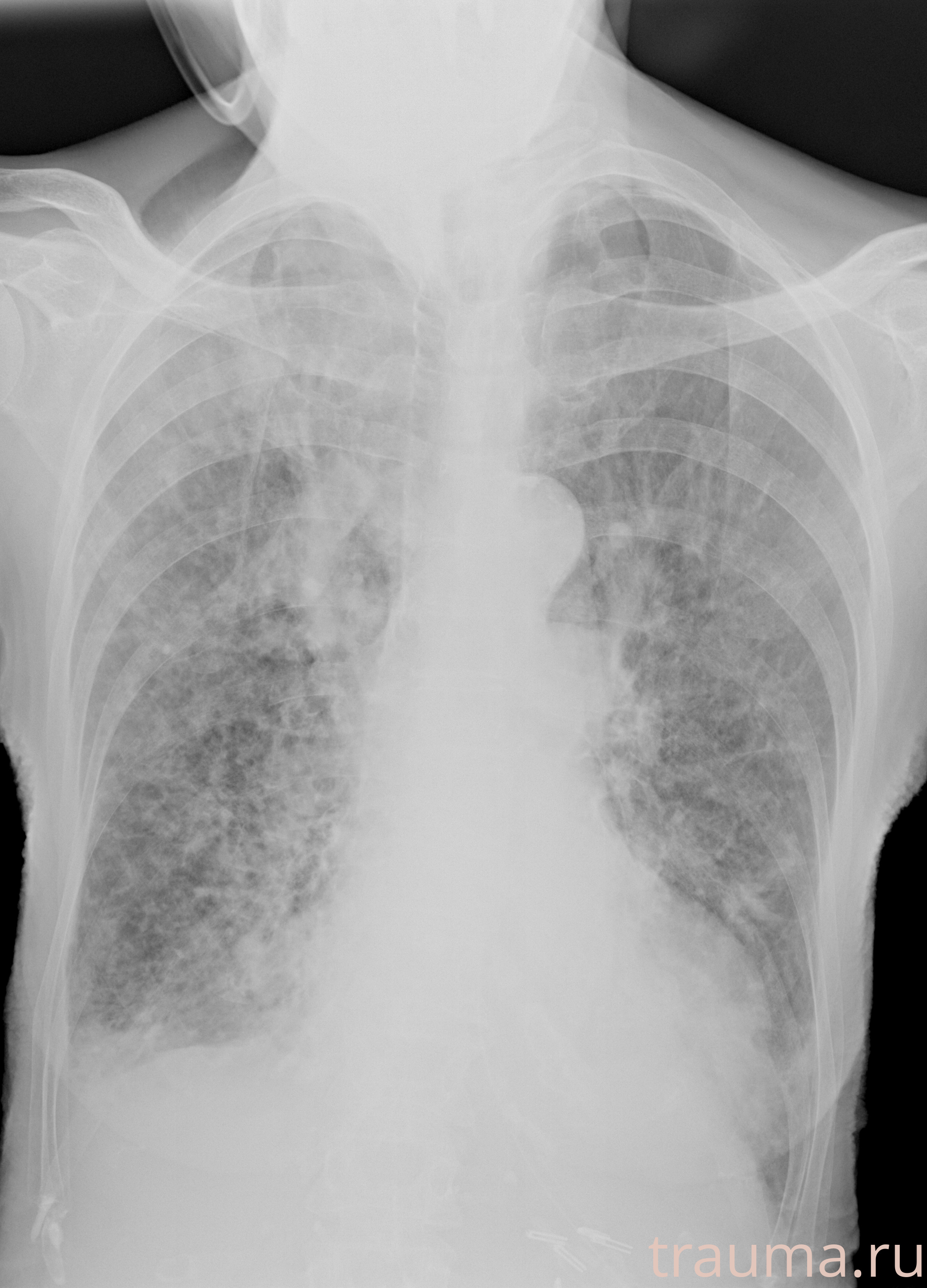 Рентген на дому: по вашему адресу приезжает врач-рентгенолог, травматолог-ортопед с мобильным рентгеновским аппаратом, проводит диагностику травмы или заболевания, делает необходимые рентгенограммы, дает рекомендации по дальнейшему лечению. Получить качественные снимки в домашних условиях возможно благодаря уникальной методике, разработанной МосРентген Центром для института  Склифосовского