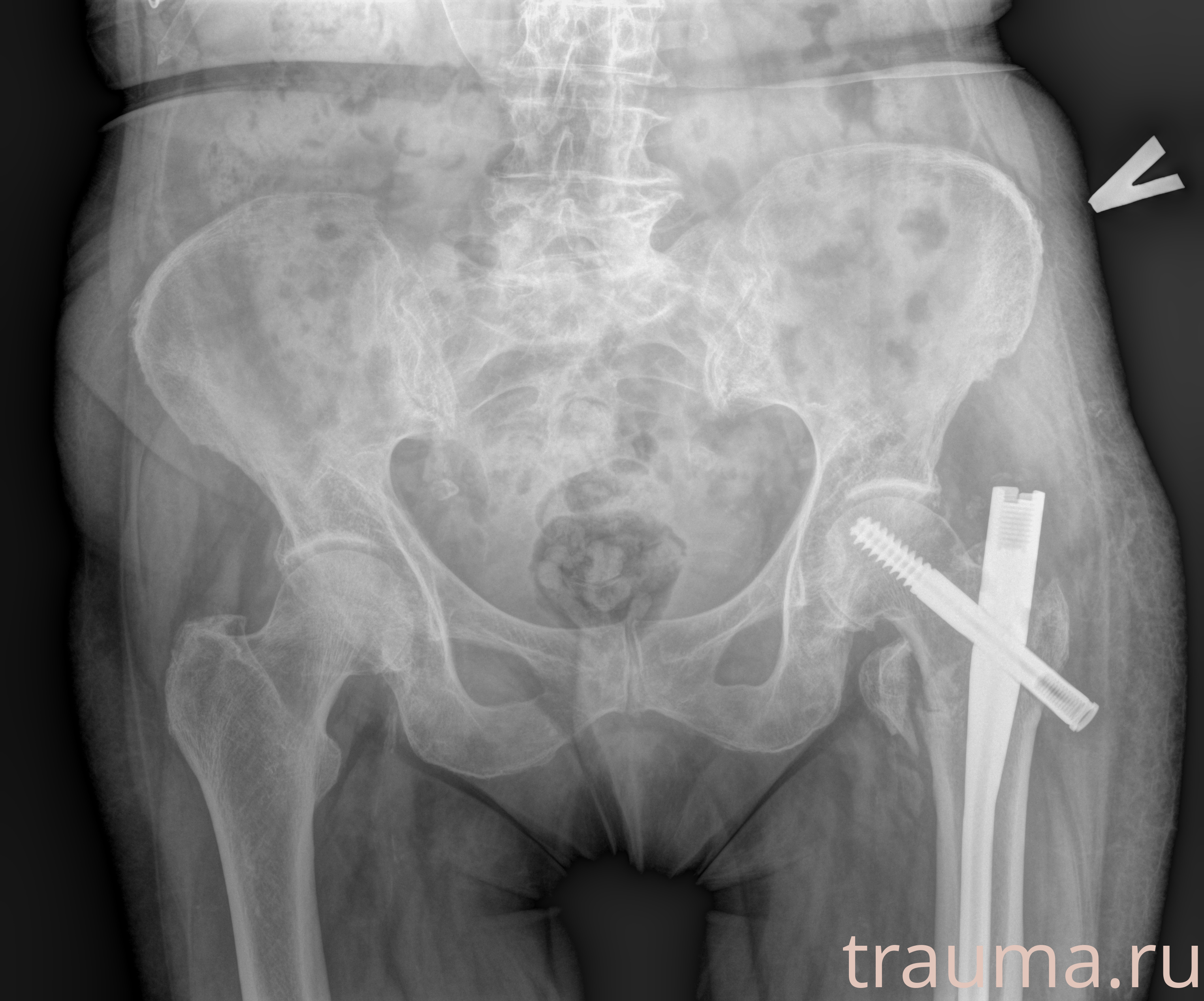 Рентген на дому: по вашему адресу приезжает врач-рентгенолог, травматолог-ортопед с мобильным рентгеновским аппаратом, проводит диагностику травмы или заболевания, делает необходимые рентгенограммы, дает рекомендации по дальнейшему лечению. Получить качественные снимки в домашних условиях возможно благодаря уникальной методике, разработанной МосРентген Центром для института  Склифосовского