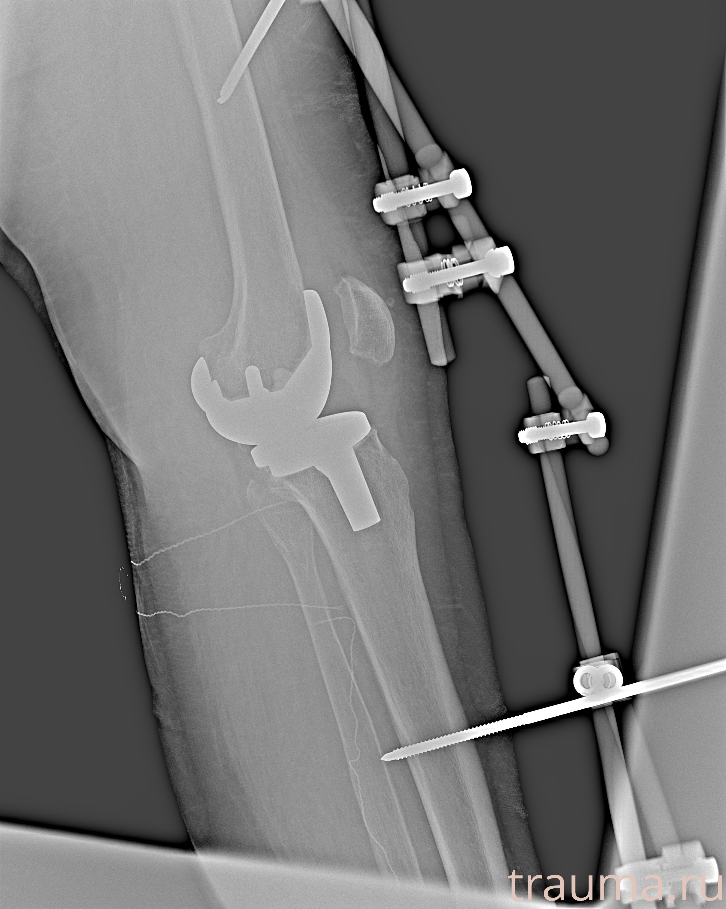 Рентген на дому: по вашему адресу приезжает врач-рентгенолог, травматолог-ортопед с мобильным рентгеновским аппаратом, проводит диагностику травмы или заболевания, делает необходимые рентгенограммы, дает рекомендации по дальнейшему лечению. Получить качественные снимки в домашних условиях возможно благодаря уникальной методике, разработанной МосРентген Центром для института  Склифосовского