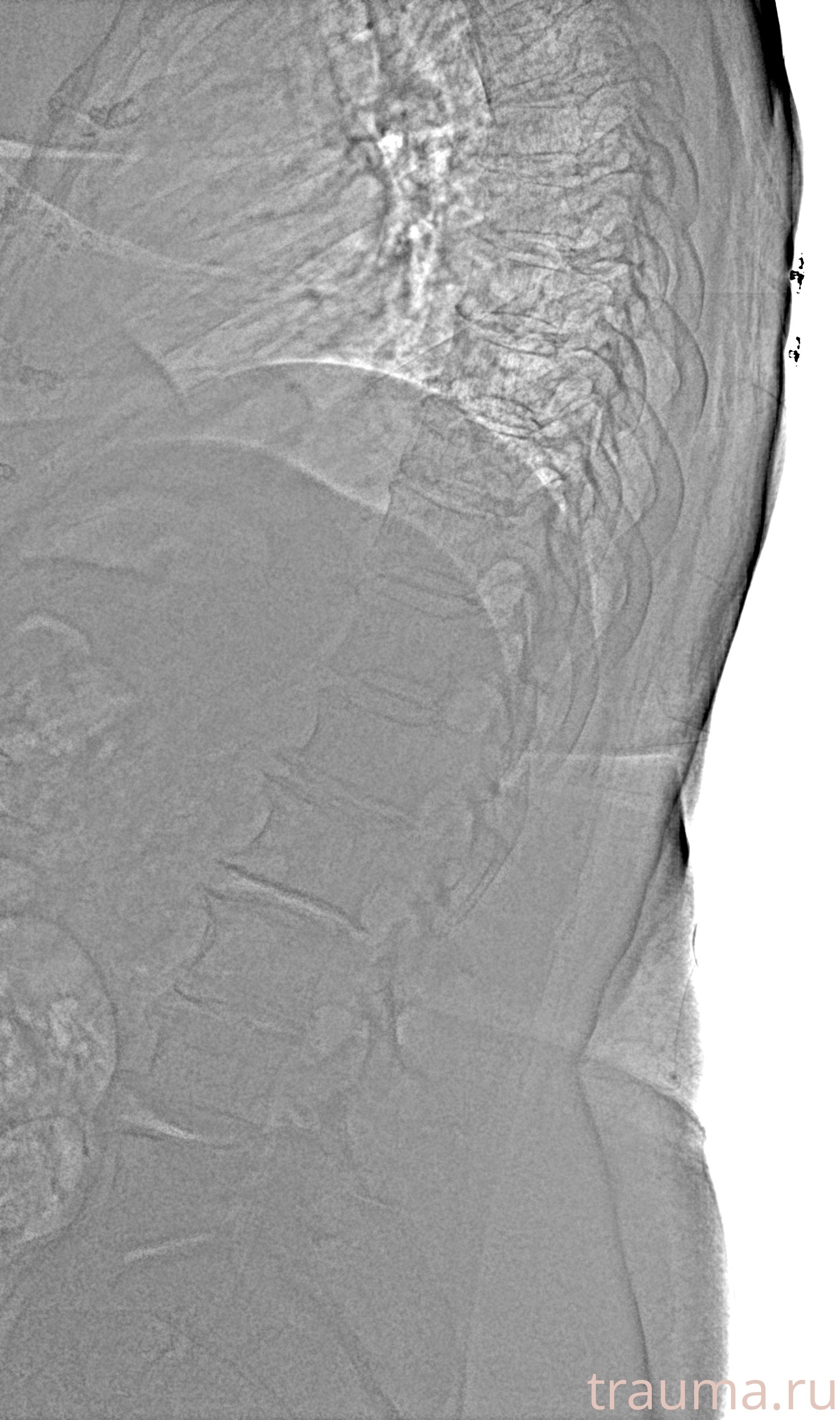 Рентген на дому: по вашему адресу приезжает врач-рентгенолог, травматолог-ортопед с мобильным рентгеновским аппаратом, проводит диагностику травмы или заболевания, делает необходимые рентгенограммы, дает рекомендации по дальнейшему лечению. Получить качественные снимки в домашних условиях возможно благодаря уникальной методике, разработанной МосРентген Центром для института  Склифосовского
