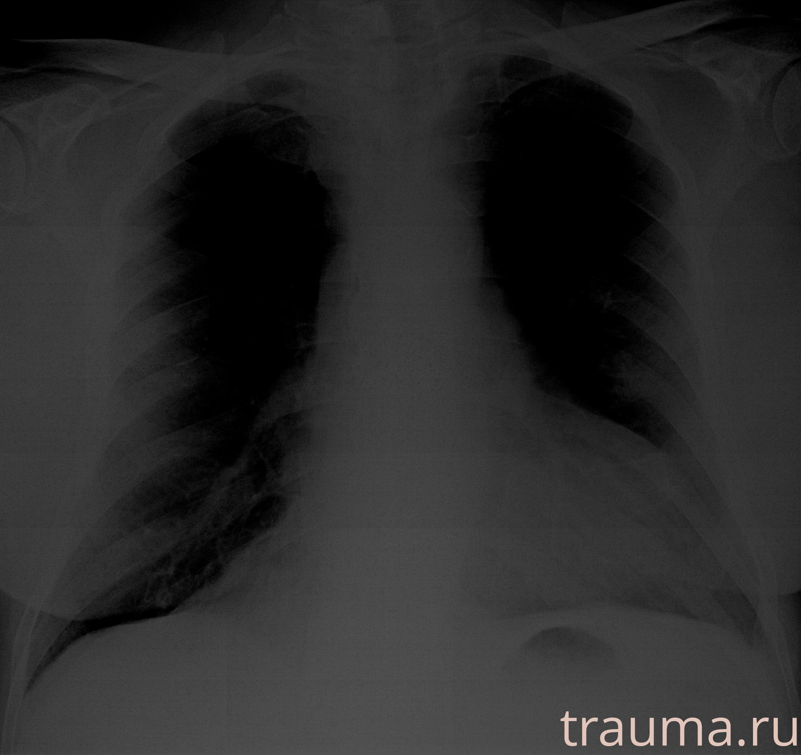 Рентген на дому: по вашему адресу приезжает врач-рентгенолог, травматолог-ортопед с мобильным рентгеновским аппаратом, проводит диагностику травмы или заболевания, делает необходимые рентгенограммы, дает рекомендации по дальнейшему лечению. Получить качественные снимки в домашних условиях возможно благодаря уникальной методике, разработанной МосРентген Центром для института  Склифосовского