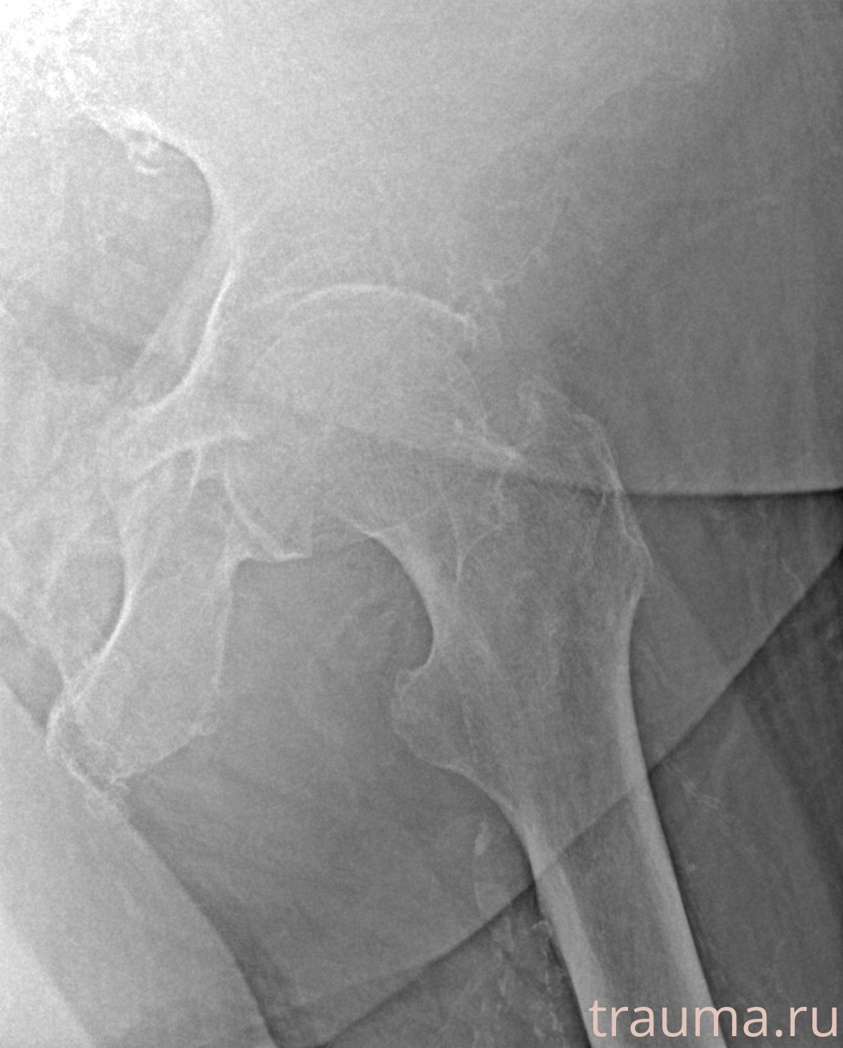 Рентген на дому: по вашему адресу приезжает врач-рентгенолог, травматолог-ортопед с мобильным рентгеновским аппаратом, проводит диагностику травмы или заболевания, делает необходимые рентгенограммы, дает рекомендации по дальнейшему лечению. Получить качественные снимки в домашних условиях возможно благодаря уникальной методике, разработанной МосРентген Центром для института  Склифосовского