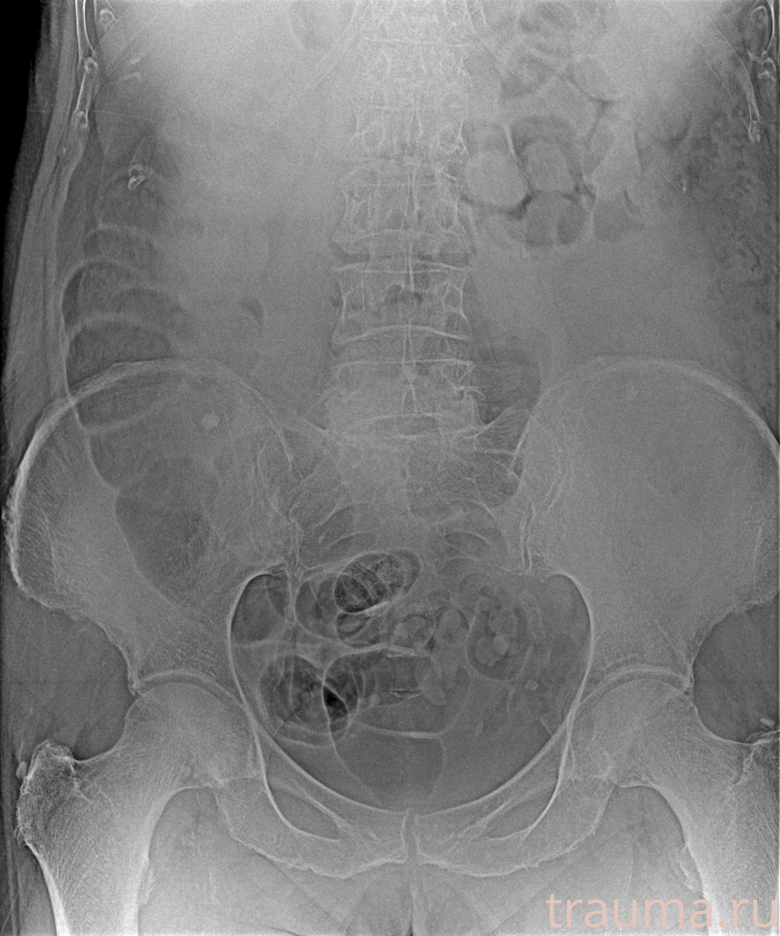 Рентген на дому: по вашему адресу приезжает врач-рентгенолог, травматолог-ортопед с мобильным рентгеновским аппаратом, проводит диагностику травмы или заболевания, делает необходимые рентгенограммы, дает рекомендации по дальнейшему лечению. Получить качественные снимки в домашних условиях возможно благодаря уникальной методике, разработанной МосРентген Центром для института  Склифосовского