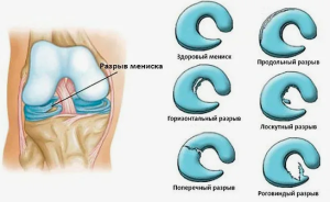 Повреждение мениска коленного сустава