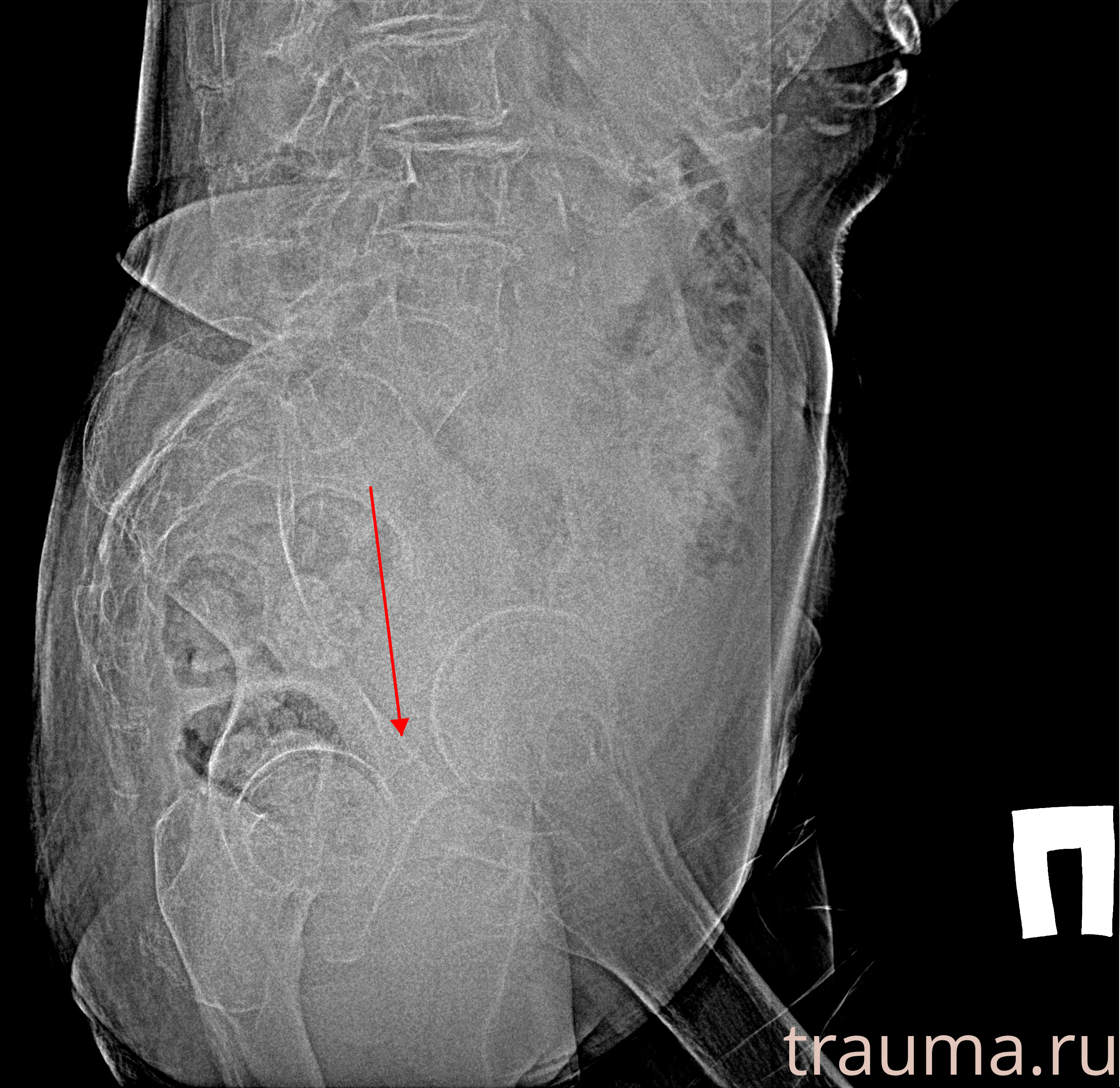 Рентген на дому: по вашему адресу приезжает врач-рентгенолог, травматолог-ортопед с мобильным рентгеновским аппаратом, проводит диагностику травмы или заболевания, делает необходимые рентгенограммы, дает рекомендации по дальнейшему лечению. Получить качественные снимки в домашних условиях возможно благодаря уникальной методике, разработанной МосРентген Центром для института  Склифосовского