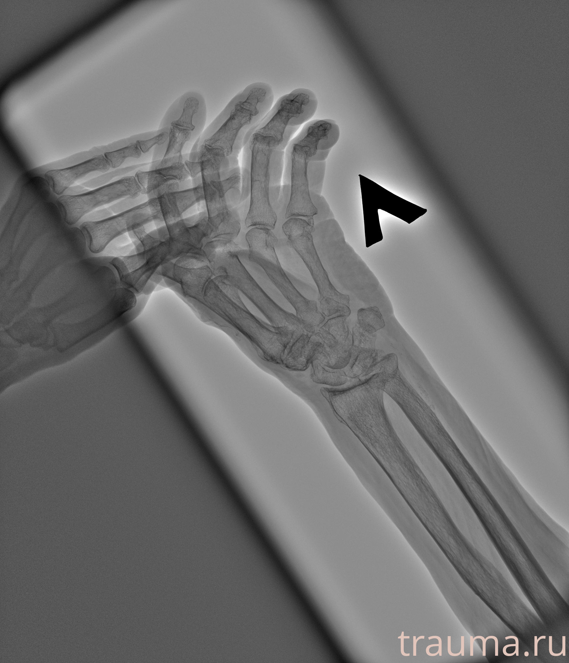 Рентген на дому: по вашему адресу приезжает врач-рентгенолог, травматолог-ортопед с мобильным рентгеновским аппаратом, проводит диагностику травмы или заболевания, делает необходимые рентгенограммы, дает рекомендации по дальнейшему лечению. Получить качественные снимки в домашних условиях возможно благодаря уникальной методике, разработанной МосРентген Центром для института  Склифосовского