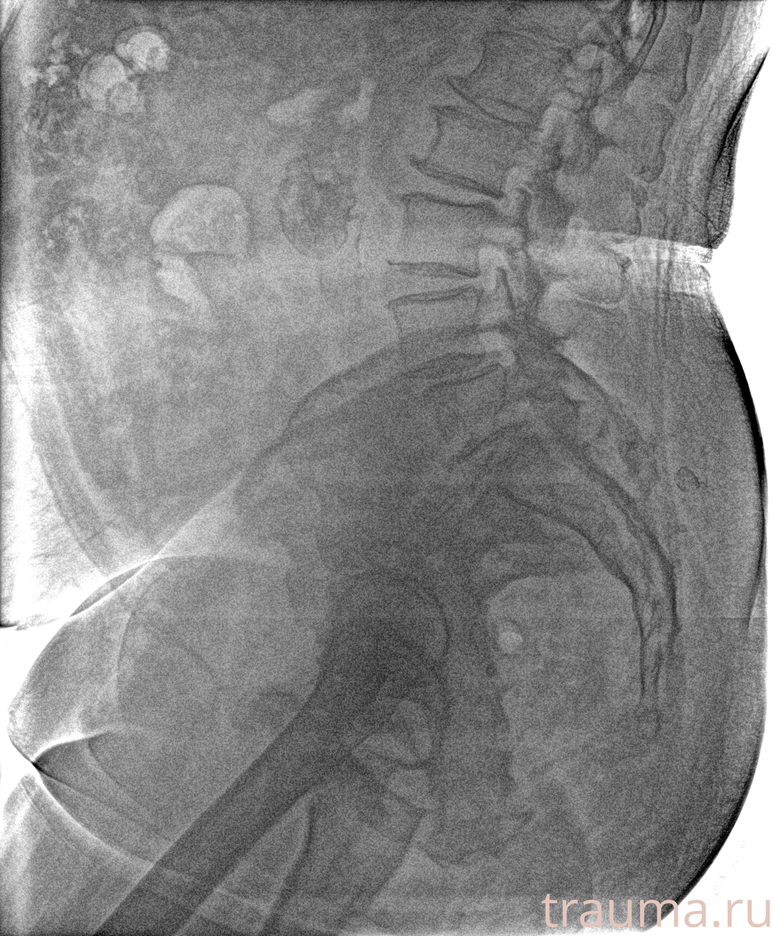 Рентген на дому: по вашему адресу приезжает врач-рентгенолог, травматолог-ортопед с мобильным рентгеновским аппаратом, проводит диагностику травмы или заболевания, делает необходимые рентгенограммы, дает рекомендации по дальнейшему лечению. Получить качественные снимки в домашних условиях возможно благодаря уникальной методике, разработанной МосРентген Центром для института  Склифосовского