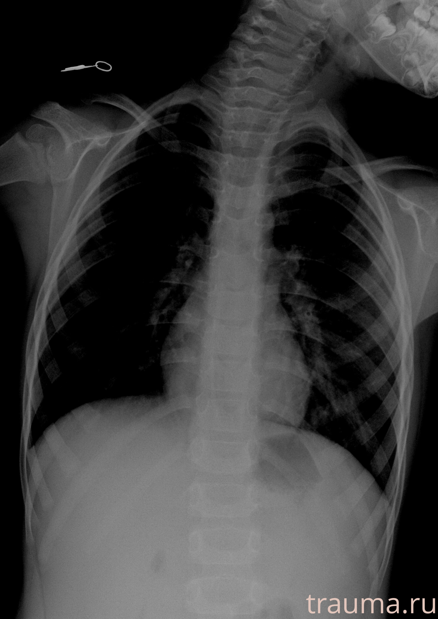 Рентген на дому: по вашему адресу приезжает врач-рентгенолог, травматолог-ортопед с мобильным рентгеновским аппаратом, проводит диагностику травмы или заболевания, делает необходимые рентгенограммы, дает рекомендации по дальнейшему лечению. Получить качественные снимки в домашних условиях возможно благодаря уникальной методике, разработанной МосРентген Центром для института  Склифосовского