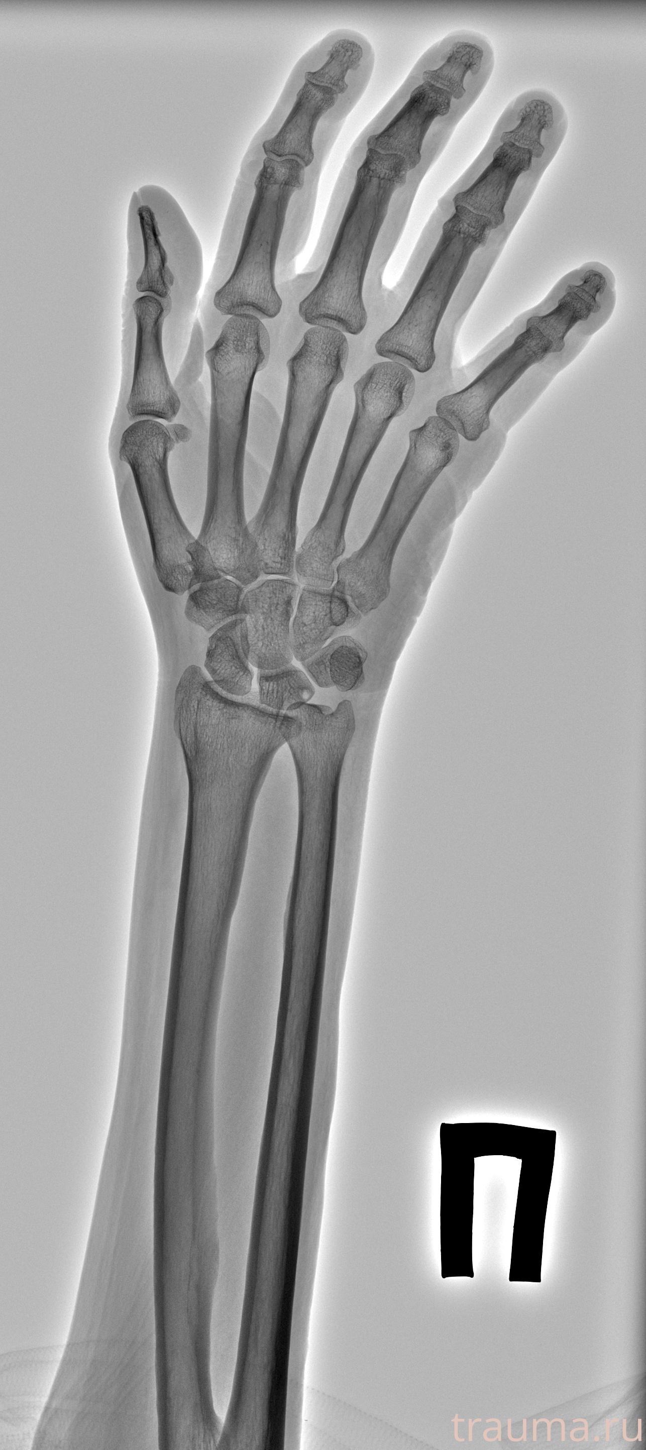 Рентген на дому: по вашему адресу приезжает врач-рентгенолог, травматолог-ортопед с мобильным рентгеновским аппаратом, проводит диагностику травмы или заболевания, делает необходимые рентгенограммы, дает рекомендации по дальнейшему лечению. Получить качественные снимки в домашних условиях возможно благодаря уникальной методике, разработанной МосРентген Центром для института  Склифосовского