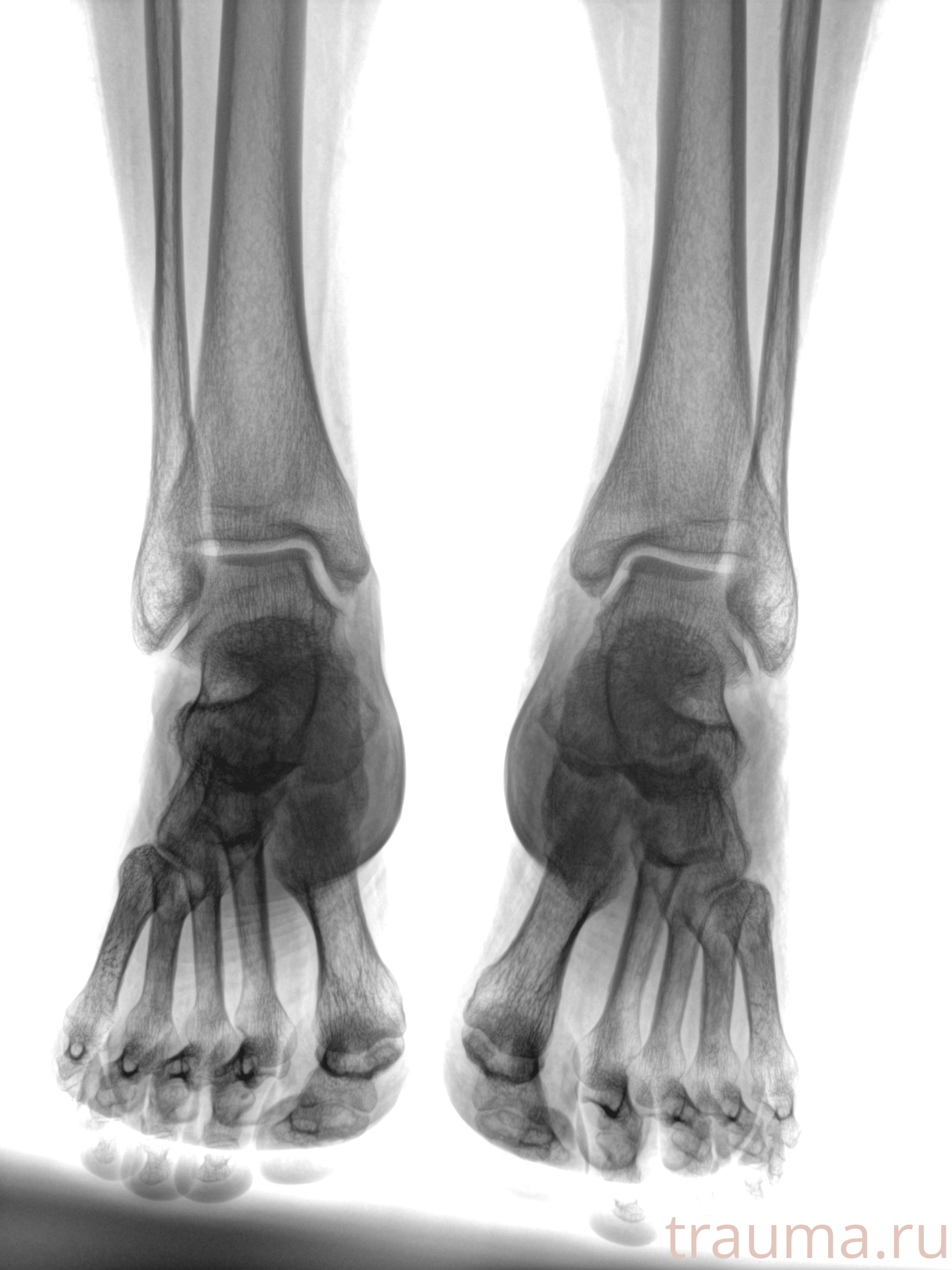 Рентген на дому: по вашему адресу приезжает врач-рентгенолог, травматолог-ортопед с мобильным рентгеновским аппаратом, проводит диагностику травмы или заболевания, делает необходимые рентгенограммы, дает рекомендации по дальнейшему лечению. Получить качественные снимки в домашних условиях возможно благодаря уникальной методике, разработанной МосРентген Центром для института  Склифосовского