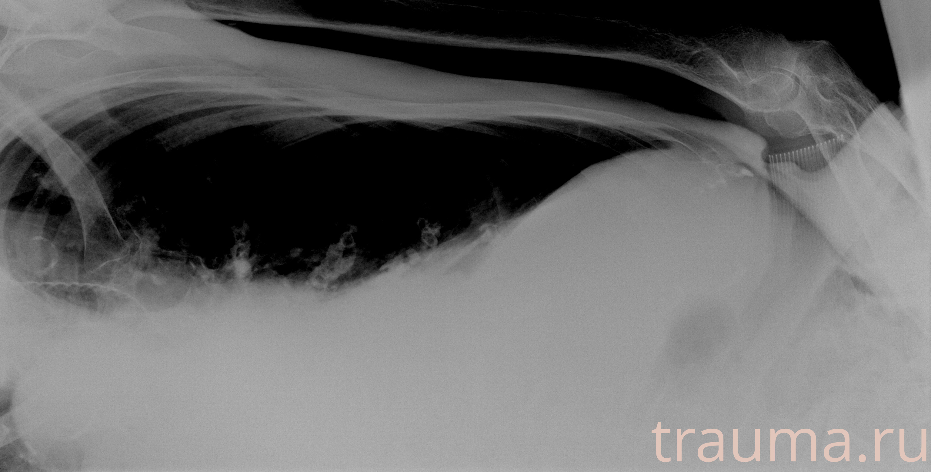 Рентген на дому: по вашему адресу приезжает врач-рентгенолог, травматолог-ортопед с мобильным рентгеновским аппаратом, проводит диагностику травмы или заболевания, делает необходимые рентгенограммы, дает рекомендации по дальнейшему лечению. Получить качественные снимки в домашних условиях возможно благодаря уникальной методике, разработанной МосРентген Центром для института  Склифосовского