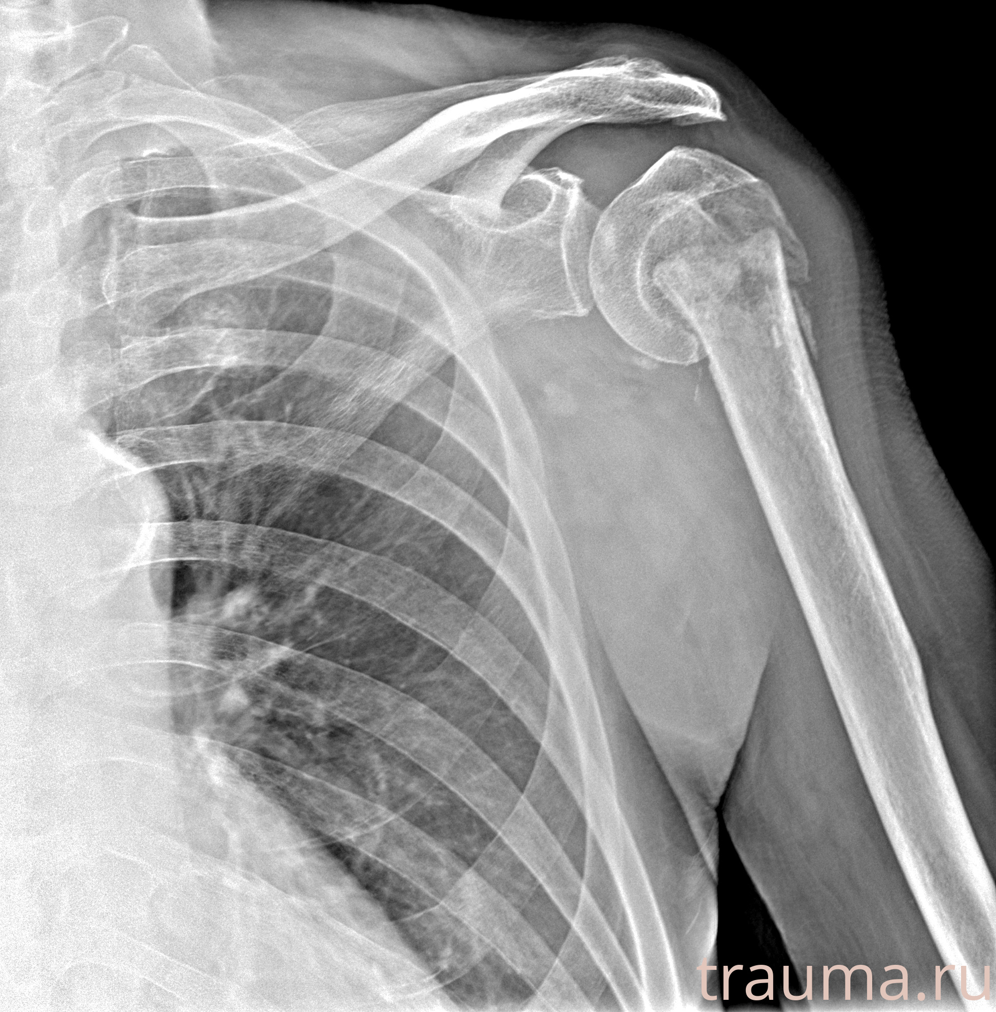 Рентген на дому: по вашему адресу приезжает врач-рентгенолог, травматолог-ортопед с мобильным рентгеновским аппаратом, проводит диагностику травмы или заболевания, делает необходимые рентгенограммы, дает рекомендации по дальнейшему лечению. Получить качественные снимки в домашних условиях возможно благодаря уникальной методике, разработанной МосРентген Центром для института  Склифосовского