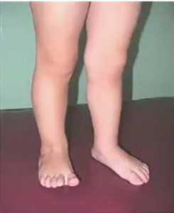 Сравнение отдаленных результатов лечения детей с косолапостью 
