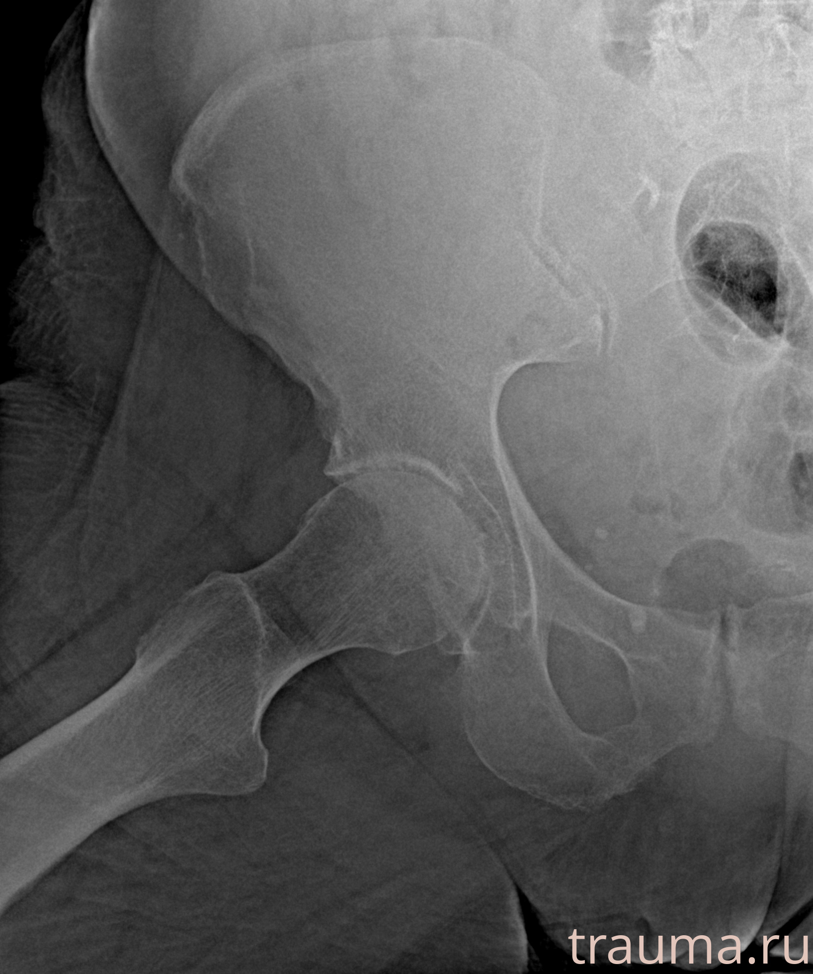 Рентген на дому: по вашему адресу приезжает врач-рентгенолог, травматолог-ортопед с мобильным рентгеновским аппаратом, проводит диагностику травмы или заболевания, делает необходимые рентгенограммы, дает рекомендации по дальнейшему лечению. Получить качественные снимки в домашних условиях возможно благодаря уникальной методике, разработанной МосРентген Центром для института  Склифосовского