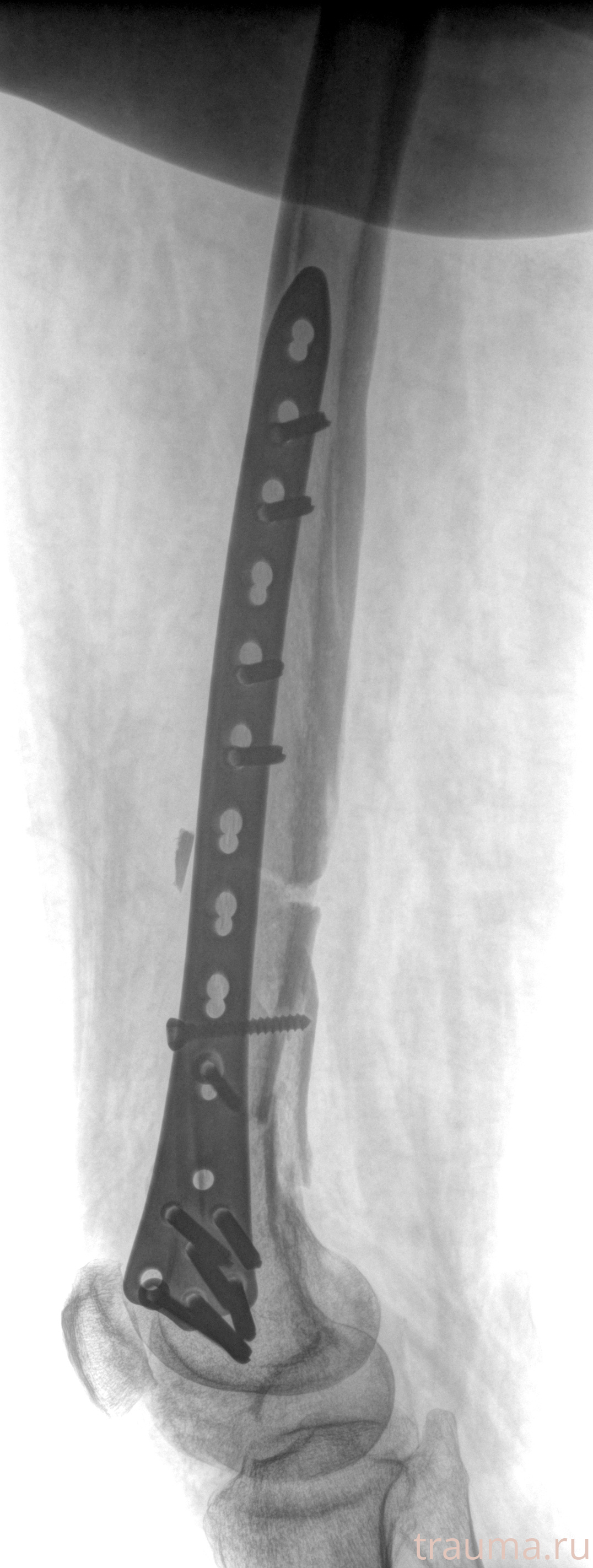 Рентген на дому: по вашему адресу приезжает врач-рентгенолог, травматолог-ортопед с мобильным рентгеновским аппаратом, проводит диагностику травмы или заболевания, делает необходимые рентгенограммы, дает рекомендации по дальнейшему лечению. Получить качественные снимки в домашних условиях возможно благодаря уникальной методике, разработанной МосРентген Центром для института  Склифосовского