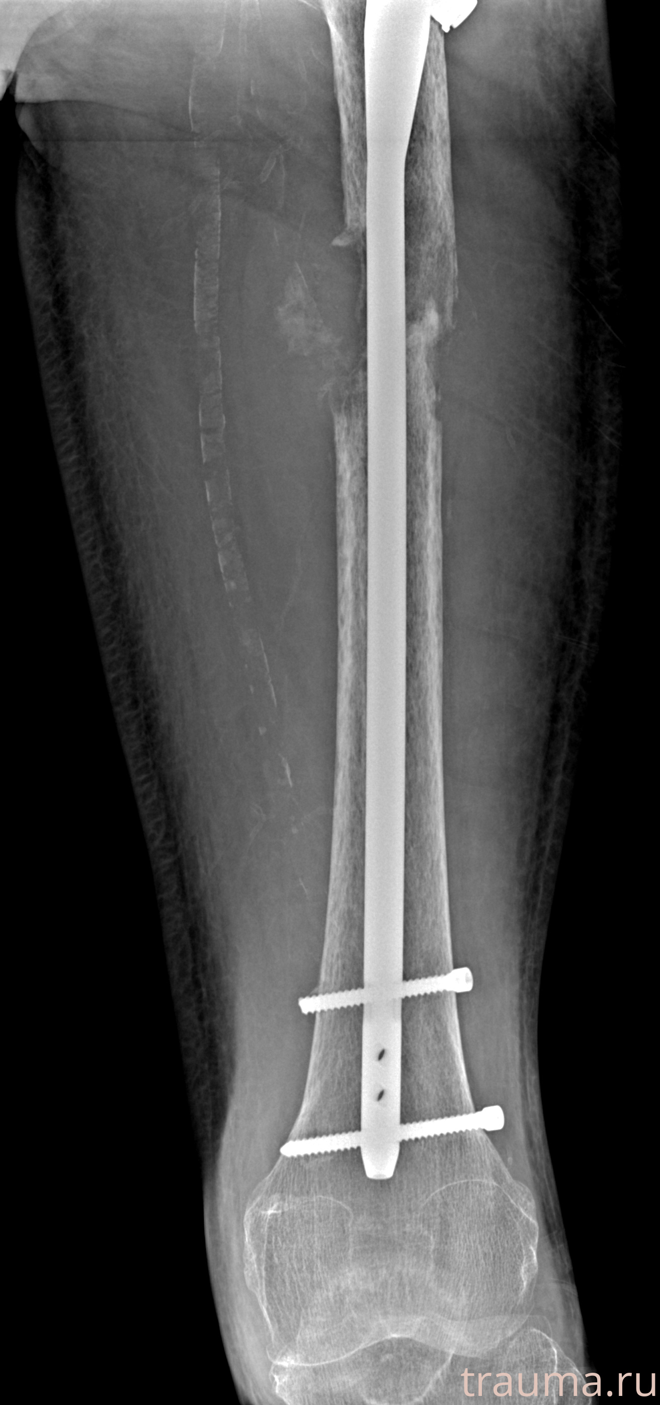 Рентген на дому: по вашему адресу приезжает врач-рентгенолог, травматолог-ортопед с мобильным рентгеновским аппаратом, проводит диагностику травмы или заболевания, делает необходимые рентгенограммы, дает рекомендации по дальнейшему лечению. Получить качественные снимки в домашних условиях возможно благодаря уникальной методике, разработанной МосРентген Центром для института  Склифосовского
