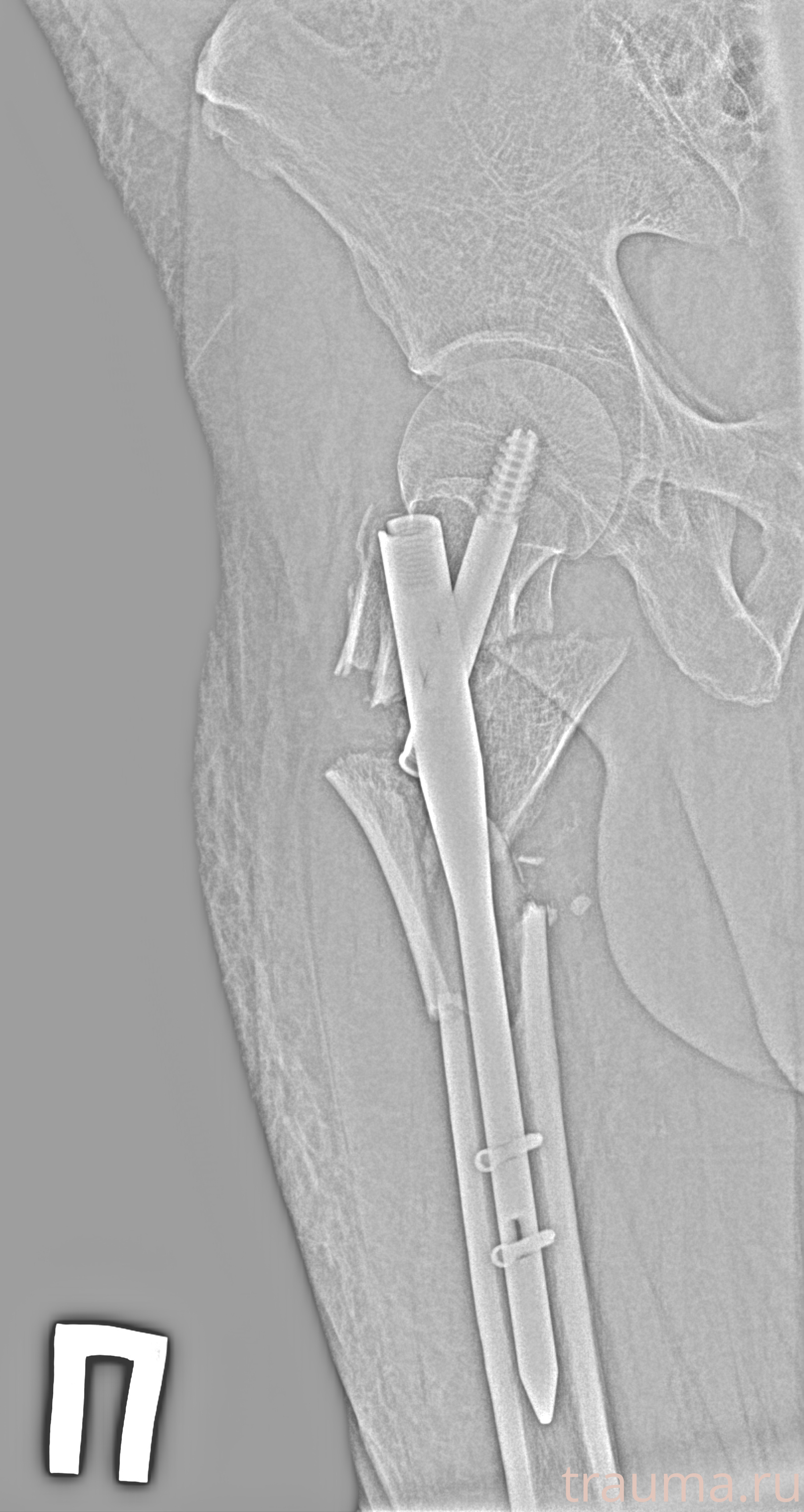 Рентген на дому: по вашему адресу приезжает врач-рентгенолог, травматолог-ортопед с мобильным рентгеновским аппаратом, проводит диагностику травмы или заболевания, делает необходимые рентгенограммы, дает рекомендации по дальнейшему лечению. Получить качественные снимки в домашних условиях возможно благодаря уникальной методике, разработанной МосРентген Центром для института  Склифосовского