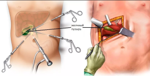 Рентгенохирургия ятрогенного повреждения желчных протоков после лапароскопической холецистэктомии (опыт одного центра)