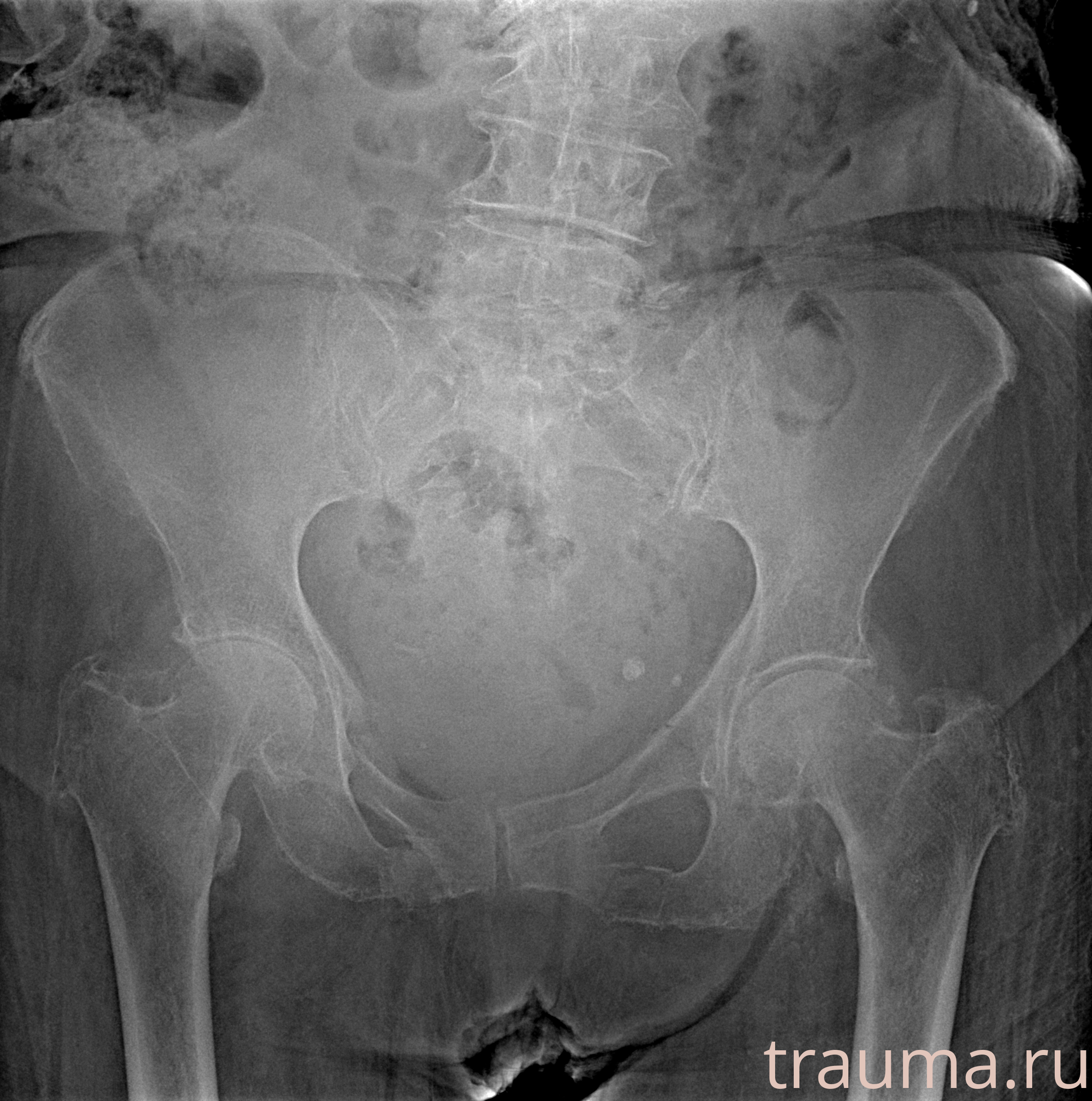 Рентген на дому: по вашему адресу приезжает врач-рентгенолог, травматолог-ортопед с мобильным рентгеновским аппаратом, проводит диагностику травмы или заболевания, делает необходимые рентгенограммы, дает рекомендации по дальнейшему лечению. Получить качественные снимки в домашних условиях возможно благодаря уникальной методике, разработанной МосРентген Центром для института  Склифосовского