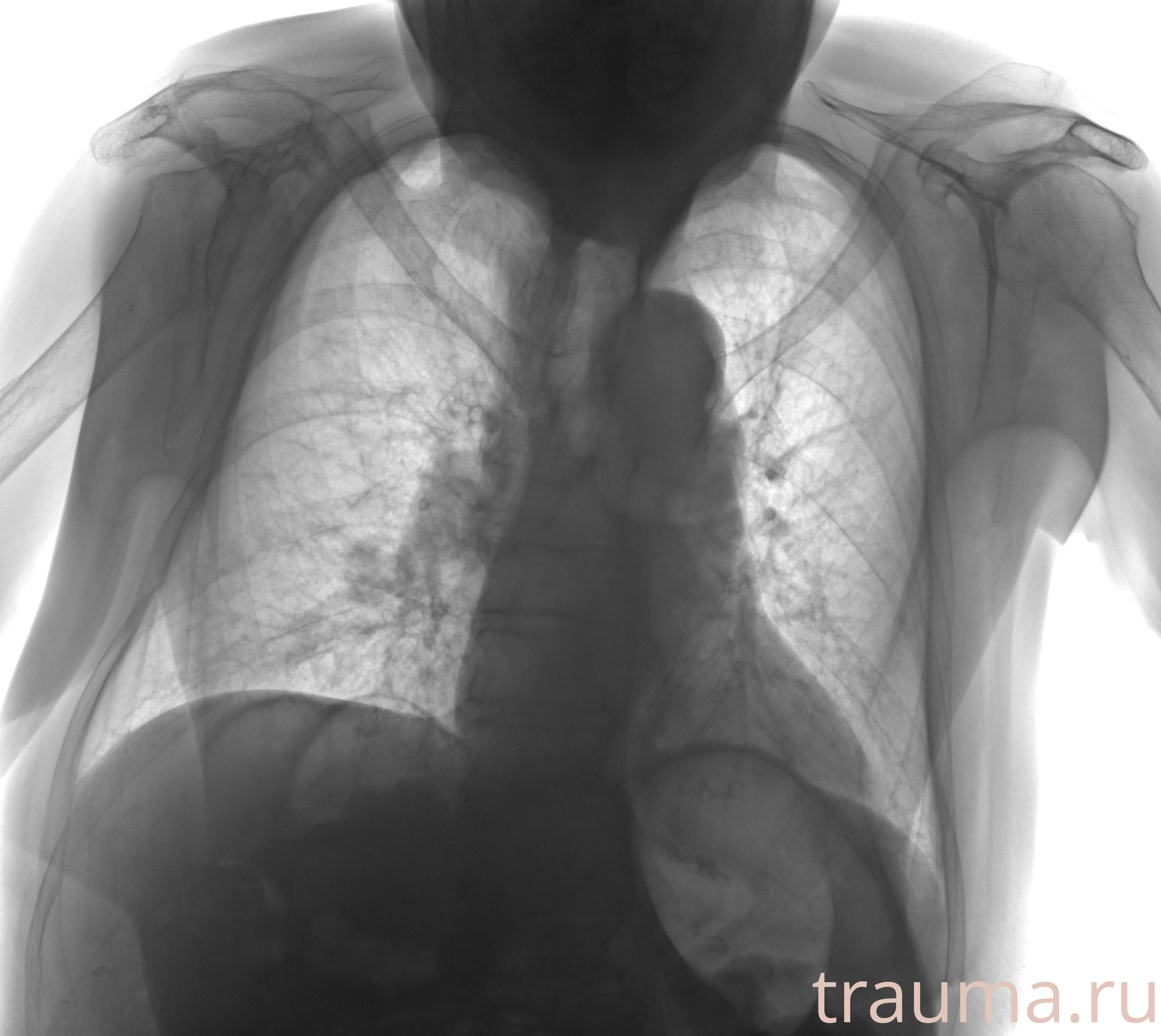 Рентген на дому: по вашему адресу приезжает врач-рентгенолог, травматолог-ортопед с мобильным рентгеновским аппаратом, проводит диагностику травмы или заболевания, делает необходимые рентгенограммы, дает рекомендации по дальнейшему лечению. Получить качественные снимки в домашних условиях возможно благодаря уникальной методике, разработанной МосРентген Центром для института  Склифосовского