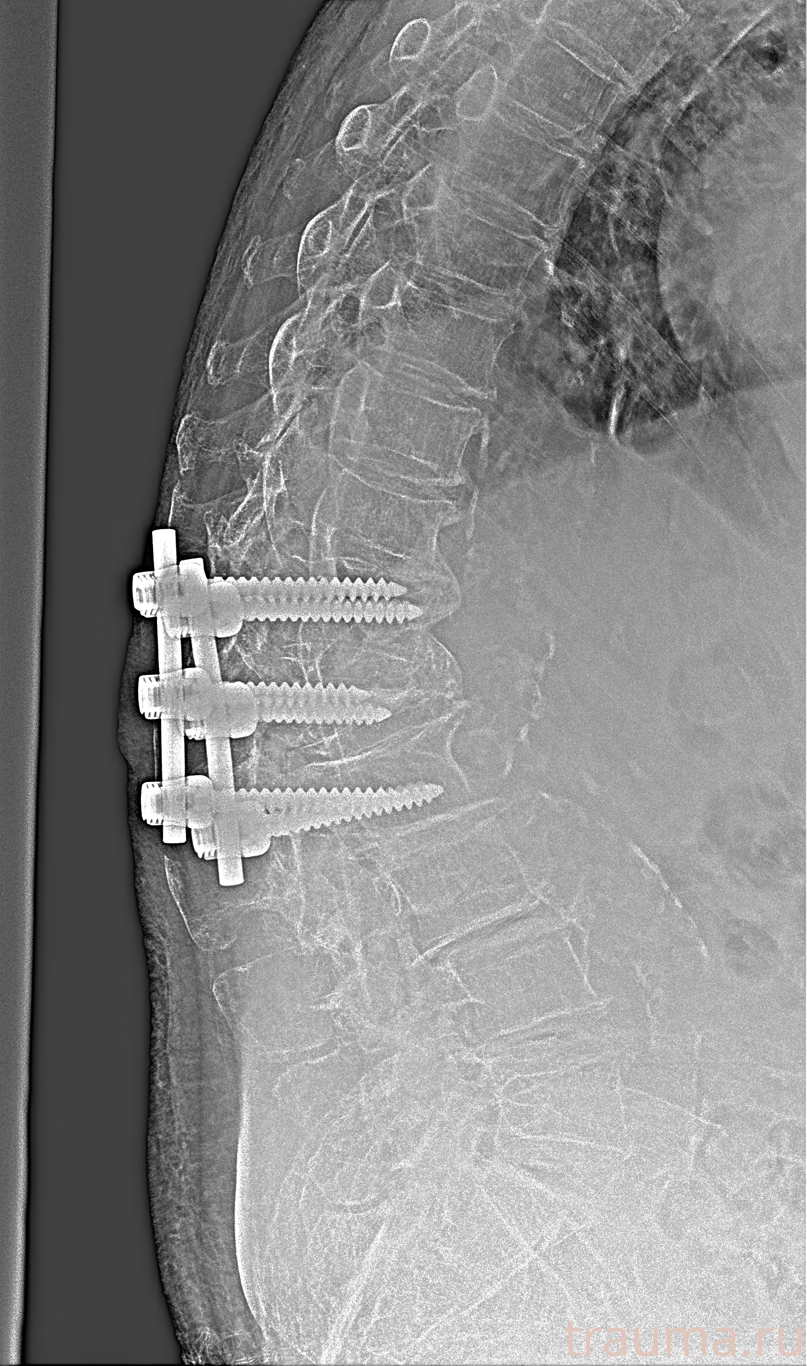 Рентген на дому: по вашему адресу приезжает врач-рентгенолог, травматолог-ортопед с мобильным рентгеновским аппаратом, проводит диагностику травмы или заболевания, делает необходимые рентгенограммы, дает рекомендации по дальнейшему лечению. Получить качественные снимки в домашних условиях возможно благодаря уникальной методике, разработанной МосРентген Центром для института  Склифосовского