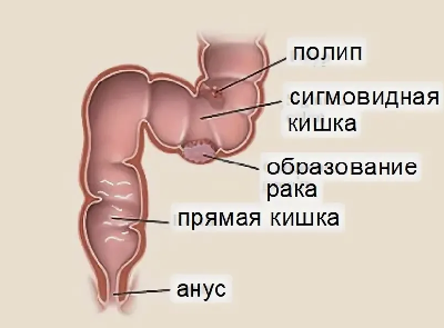 20 сантиметров в диаметре - на столько увеличилась кишка у пациента Склифа