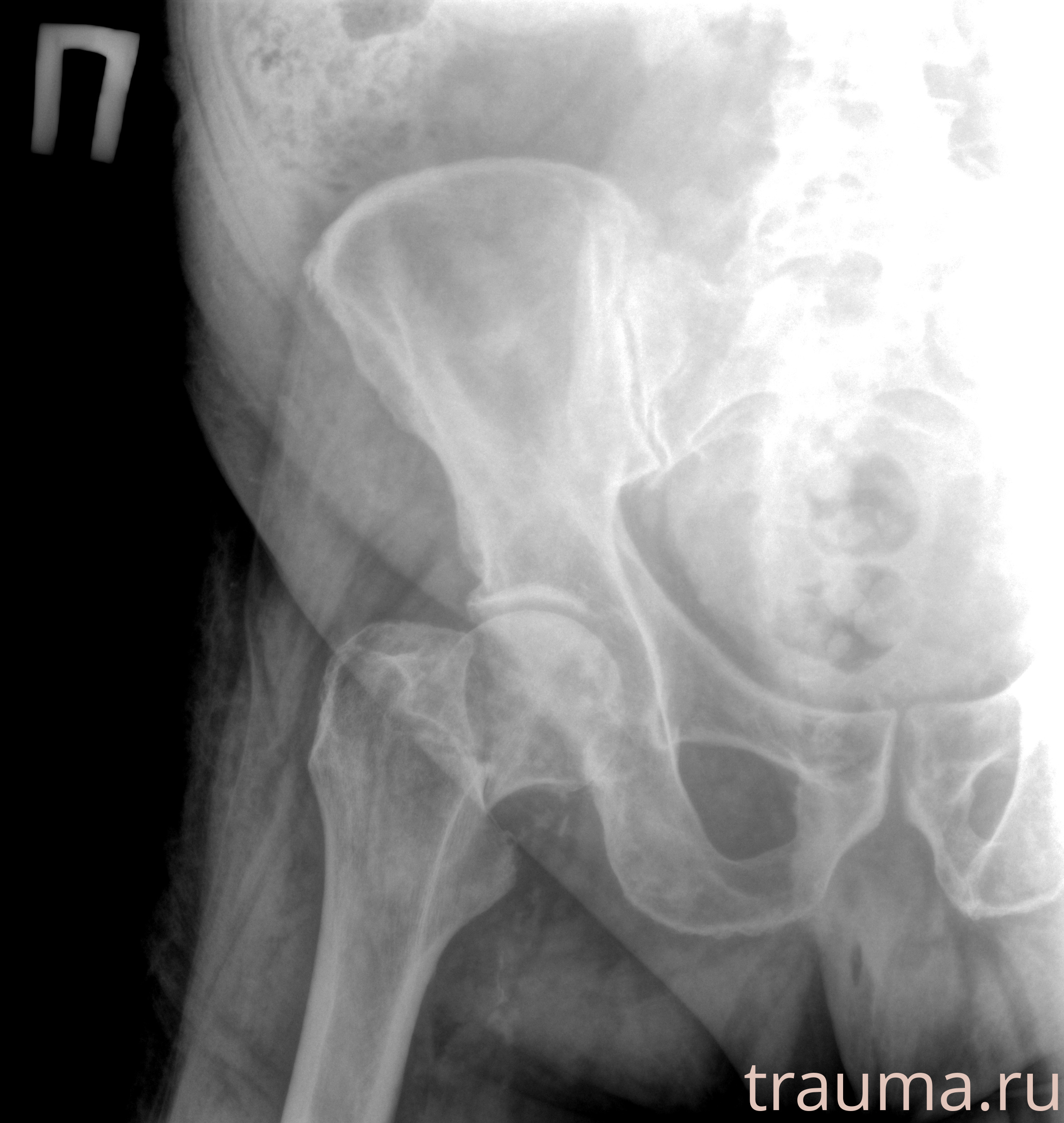 Рентген на дому: по вашему адресу приезжает врач-рентгенолог, травматолог-ортопед с мобильным рентгеновским аппаратом, проводит диагностику травмы или заболевания, делает необходимые рентгенограммы, дает рекомендации по дальнейшему лечению. Получить качественные снимки в домашних условиях возможно благодаря уникальной методике, разработанной МосРентген Центром для института  Склифосовского