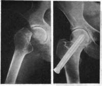 Некоторые аспекты консолидации оскольчатых переломов
бедренной кости