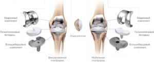 Новый вариант пластики тибиального плато большеберцовой кости при эндопротезировании коленного сустава