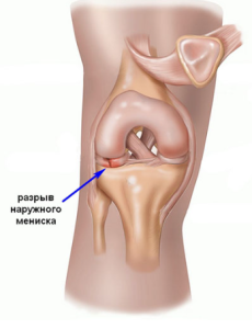 Актуальные вопросы лечения разрыва корня мениска 
