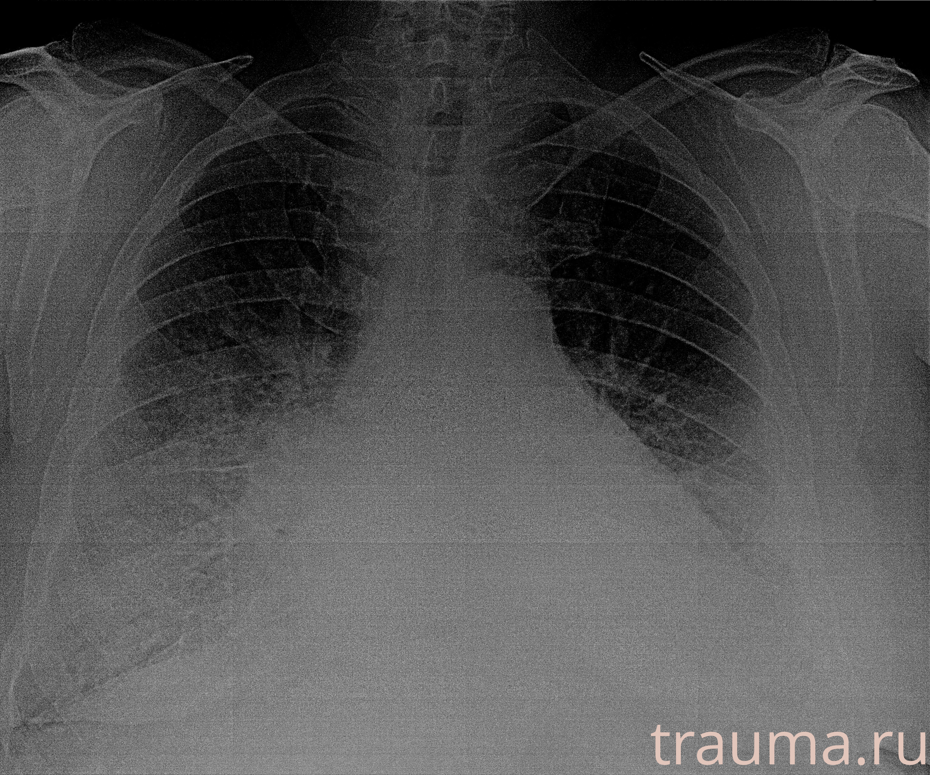 Рентген на дому: по вашему адресу приезжает врач-рентгенолог, травматолог-ортопед с мобильным рентгеновским аппаратом, проводит диагностику травмы или заболевания, делает необходимые рентгенограммы, дает рекомендации по дальнейшему лечению. Получить качественные снимки в домашних условиях возможно благодаря уникальной методике, разработанной МосРентген Центром для института  Склифосовского