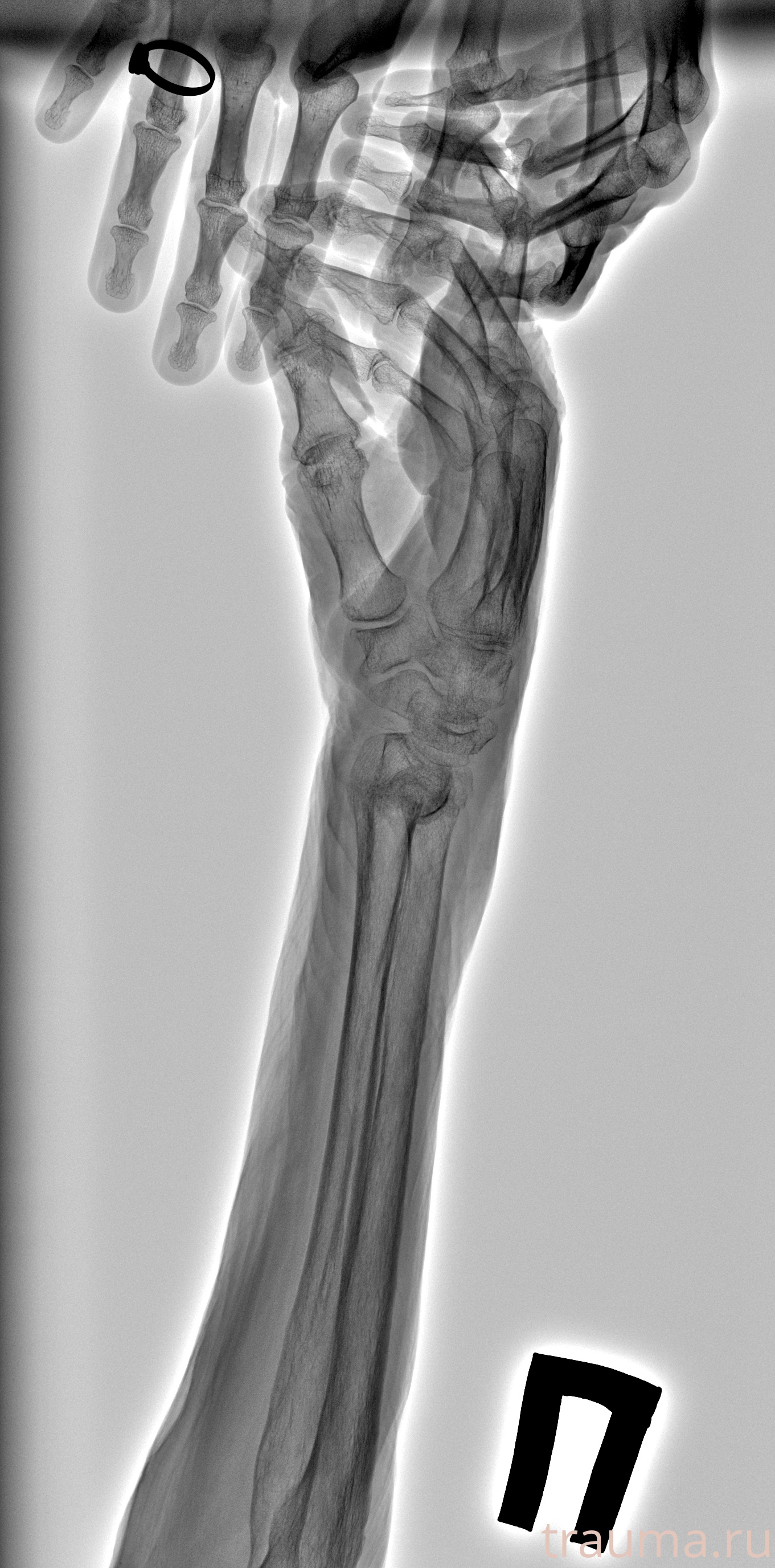 Рентген на дому: по вашему адресу приезжает врач-рентгенолог, травматолог-ортопед с мобильным рентгеновским аппаратом, проводит диагностику травмы или заболевания, делает необходимые рентгенограммы, дает рекомендации по дальнейшему лечению. Получить качественные снимки в домашних условиях возможно благодаря уникальной методике, разработанной МосРентген Центром для института  Склифосовского