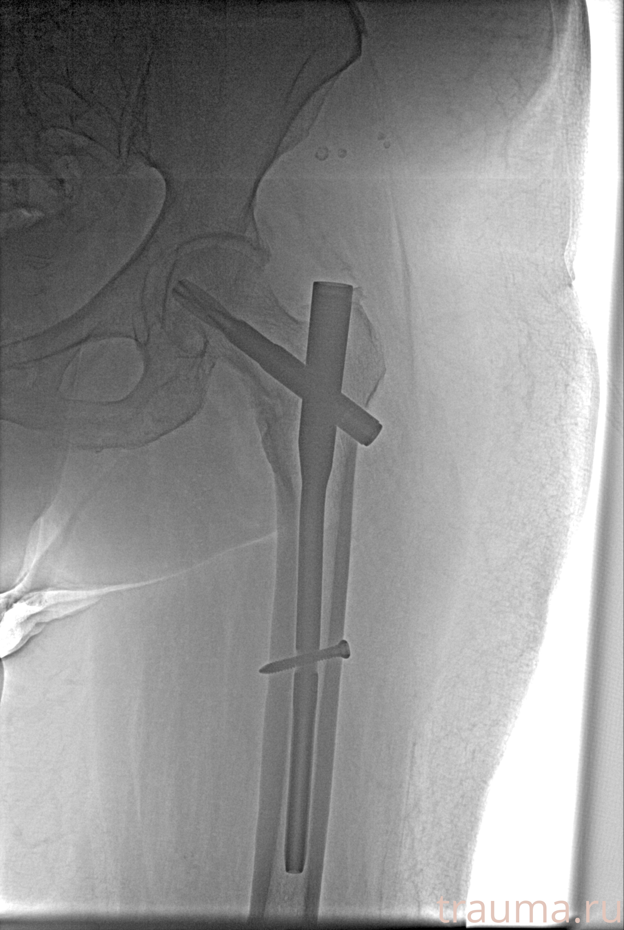 Рентген на дому: по вашему адресу приезжает врач-рентгенолог, травматолог-ортопед с мобильным рентгеновским аппаратом, проводит диагностику травмы или заболевания, делает необходимые рентгенограммы, дает рекомендации по дальнейшему лечению. Получить качественные снимки в домашних условиях возможно благодаря уникальной методике, разработанной МосРентген Центром для института  Склифосовского