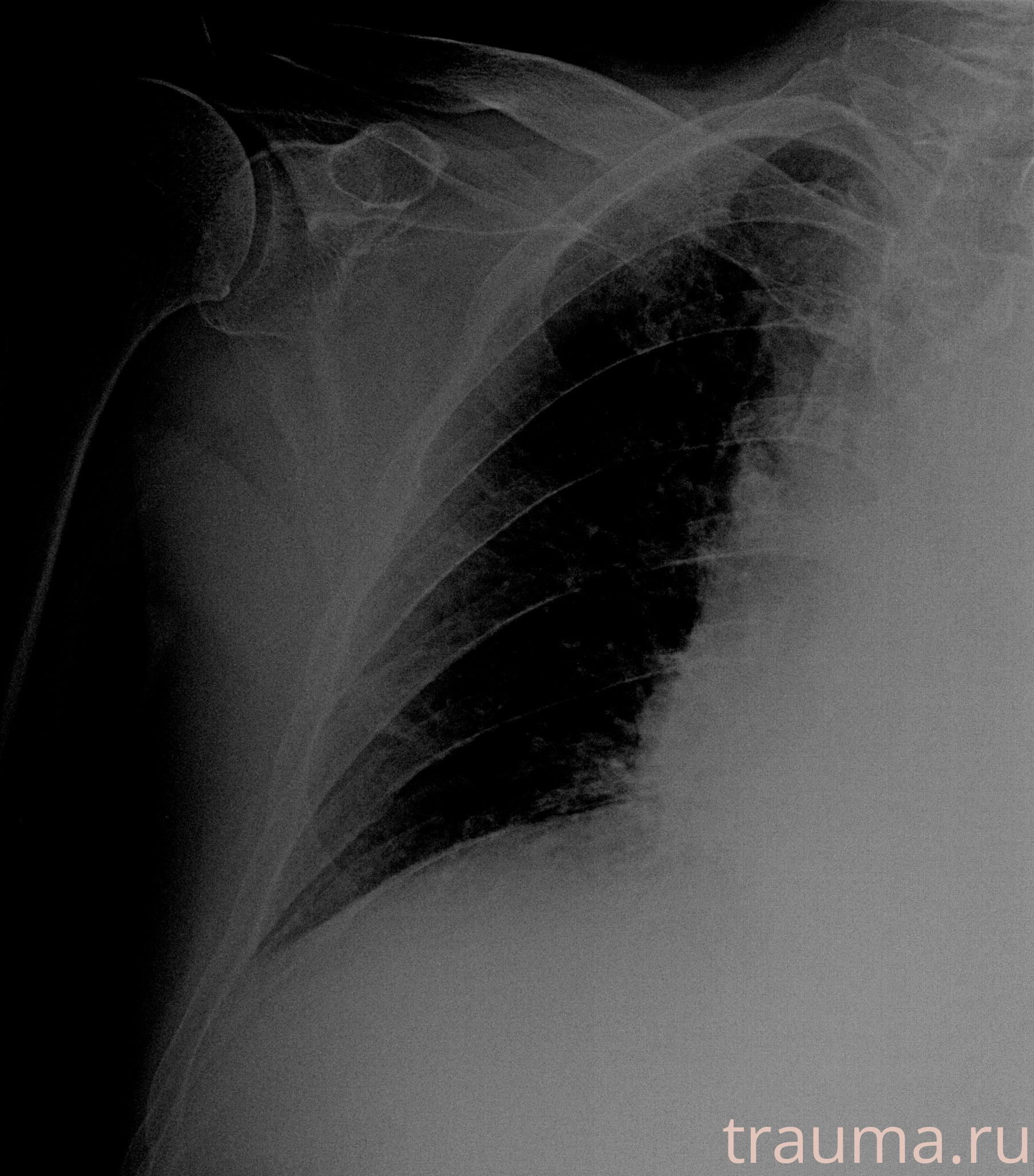 Рентген на дому: по вашему адресу приезжает врач-рентгенолог, травматолог-ортопед с мобильным рентгеновским аппаратом, проводит диагностику травмы или заболевания, делает необходимые рентгенограммы, дает рекомендации по дальнейшему лечению. Получить качественные снимки в домашних условиях возможно благодаря уникальной методике, разработанной МосРентген Центром для института  Склифосовского
