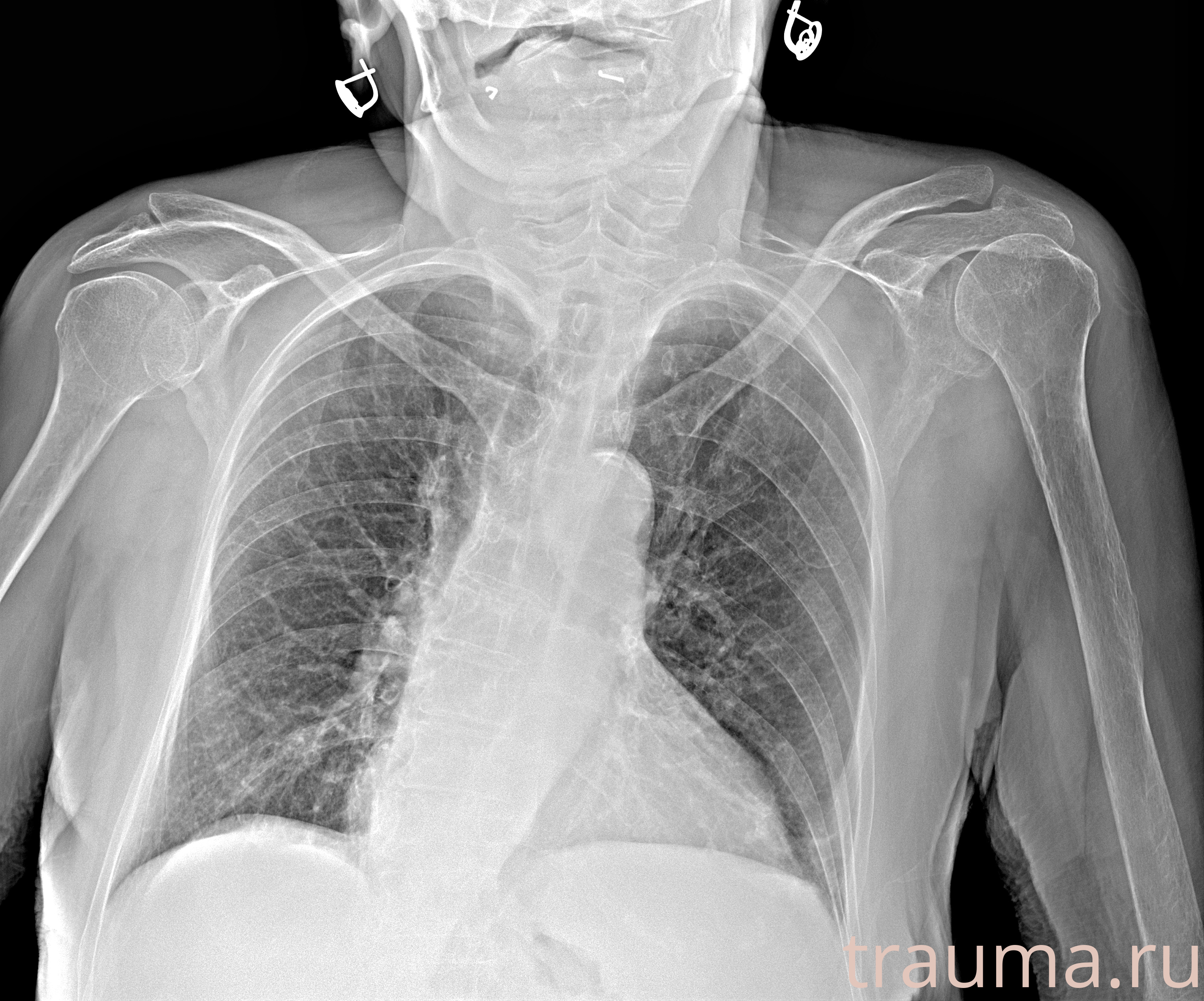 Рентген на дому: по вашему адресу приезжает врач-рентгенолог, травматолог-ортопед с мобильным рентгеновским аппаратом, проводит диагностику травмы или заболевания, делает необходимые рентгенограммы, дает рекомендации по дальнейшему лечению. Получить качественные снимки в домашних условиях возможно благодаря уникальной методике, разработанной МосРентген Центром для института  Склифосовского