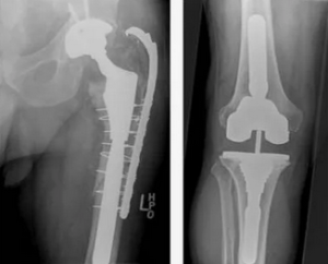 Оценка объема кровопотери в периоперационный период при эндопротезировании крупных суставов нижних конечностей