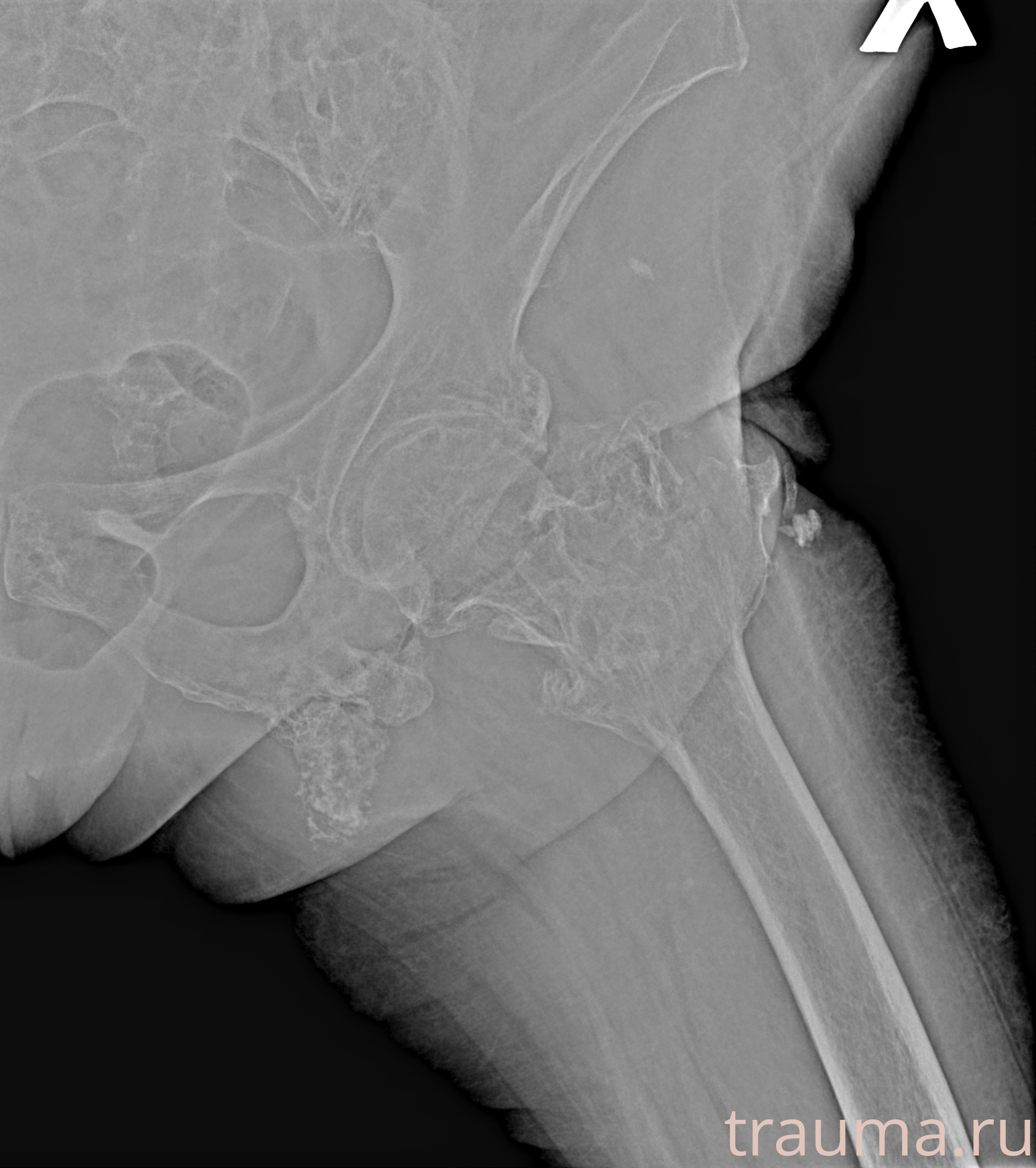Рентген на дому: по вашему адресу приезжает врач-рентгенолог, травматолог-ортопед с мобильным рентгеновским аппаратом, проводит диагностику травмы или заболевания, делает необходимые рентгенограммы, дает рекомендации по дальнейшему лечению. Получить качественные снимки в домашних условиях возможно благодаря уникальной методике, разработанной МосРентген Центром для института  Склифосовского